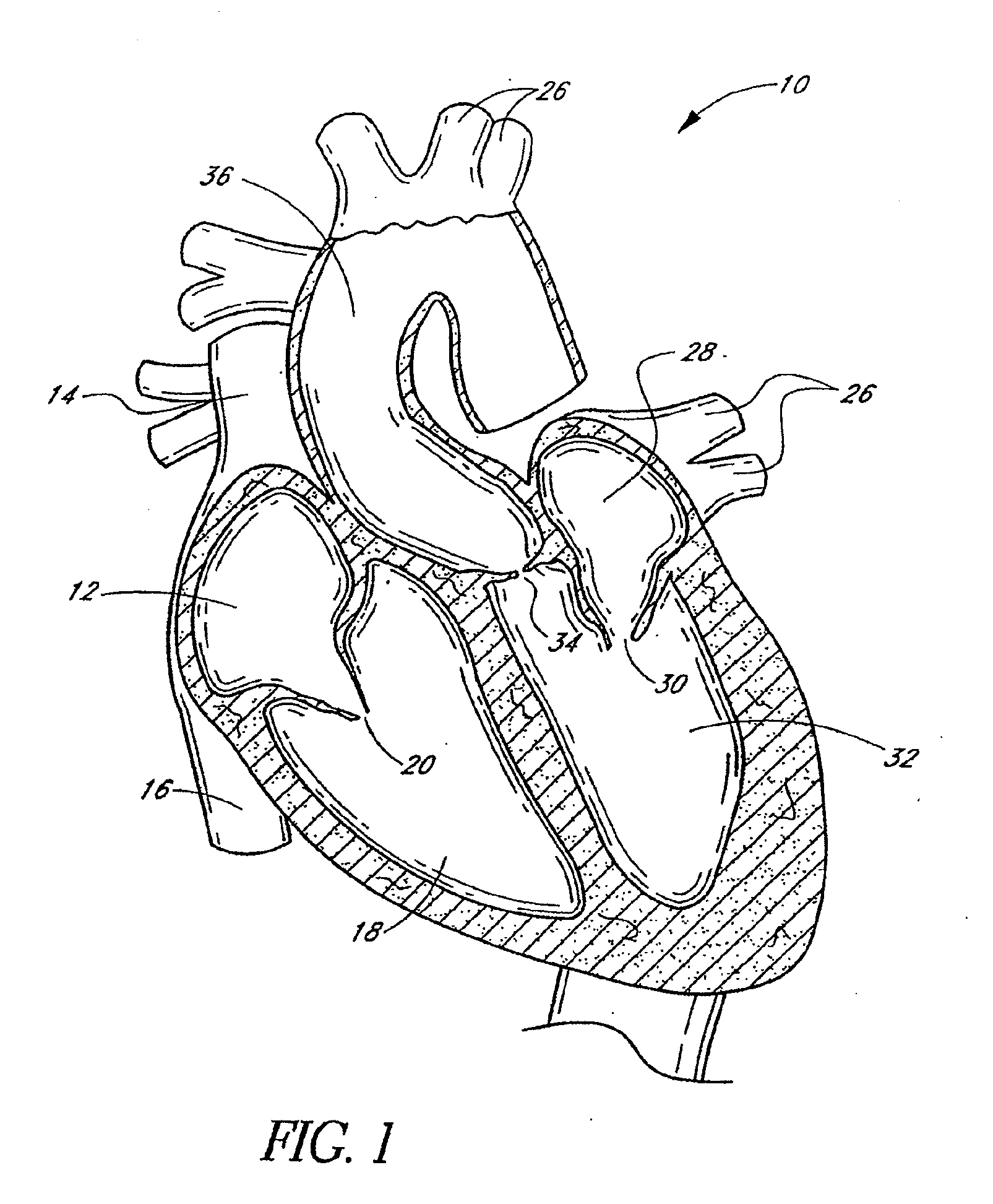 Inflation media for implants