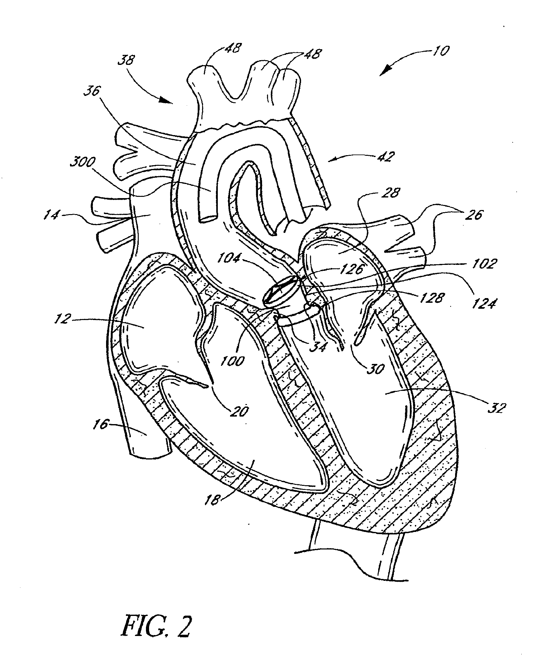 Inflation media for implants