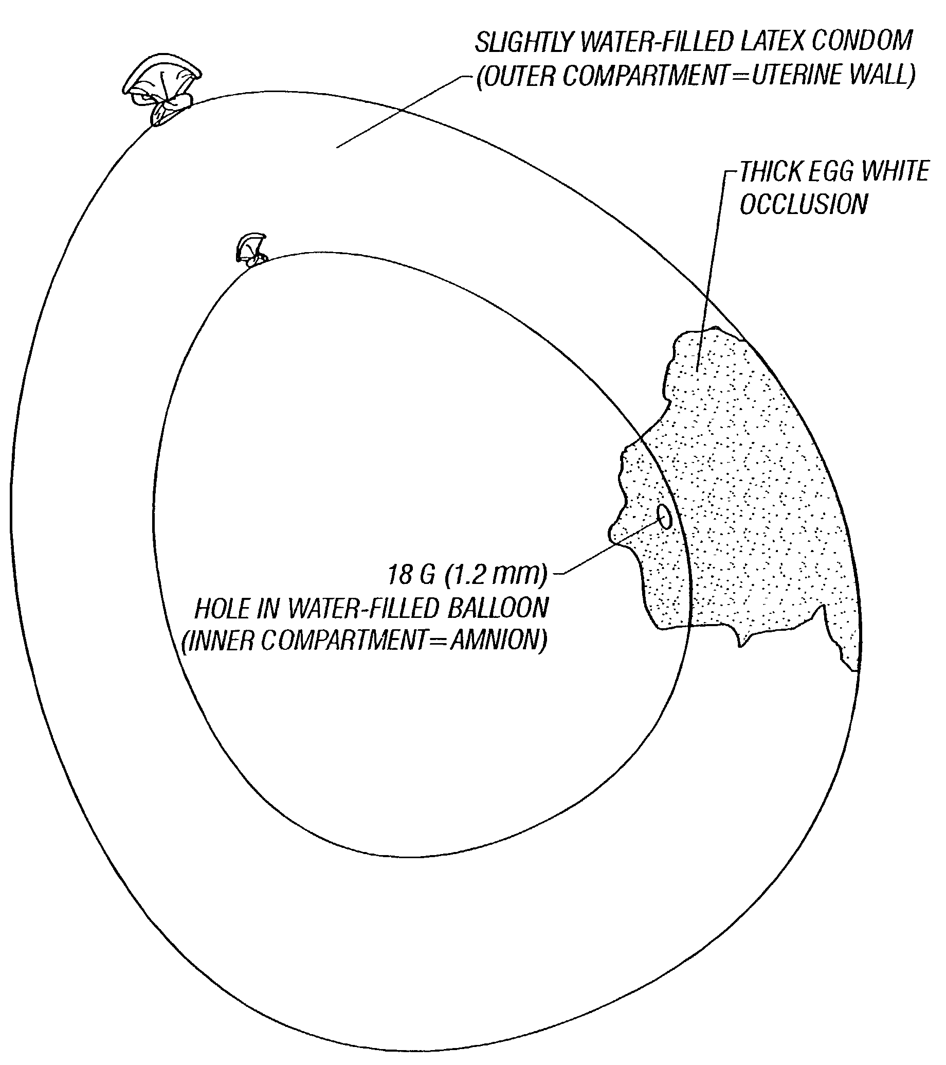 Repair of ruptured membrane by injection of naturally occurring protein in amniotic fluid sac