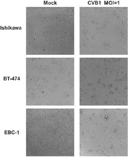 Coxsackie B virus for treatment of tumors