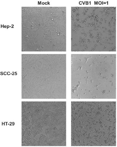 Coxsackie B virus for treatment of tumors