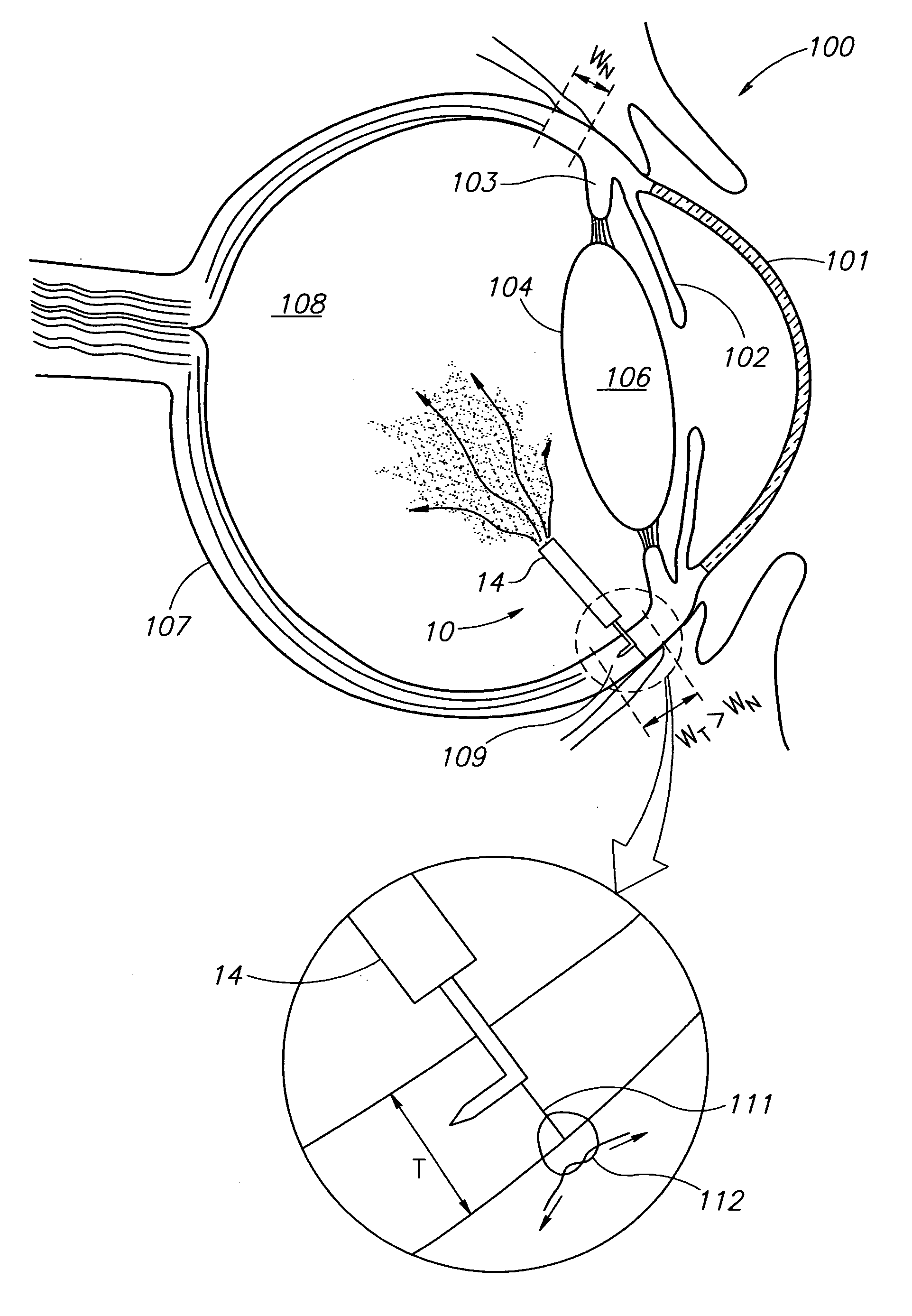 Eye wall anchored fixtures