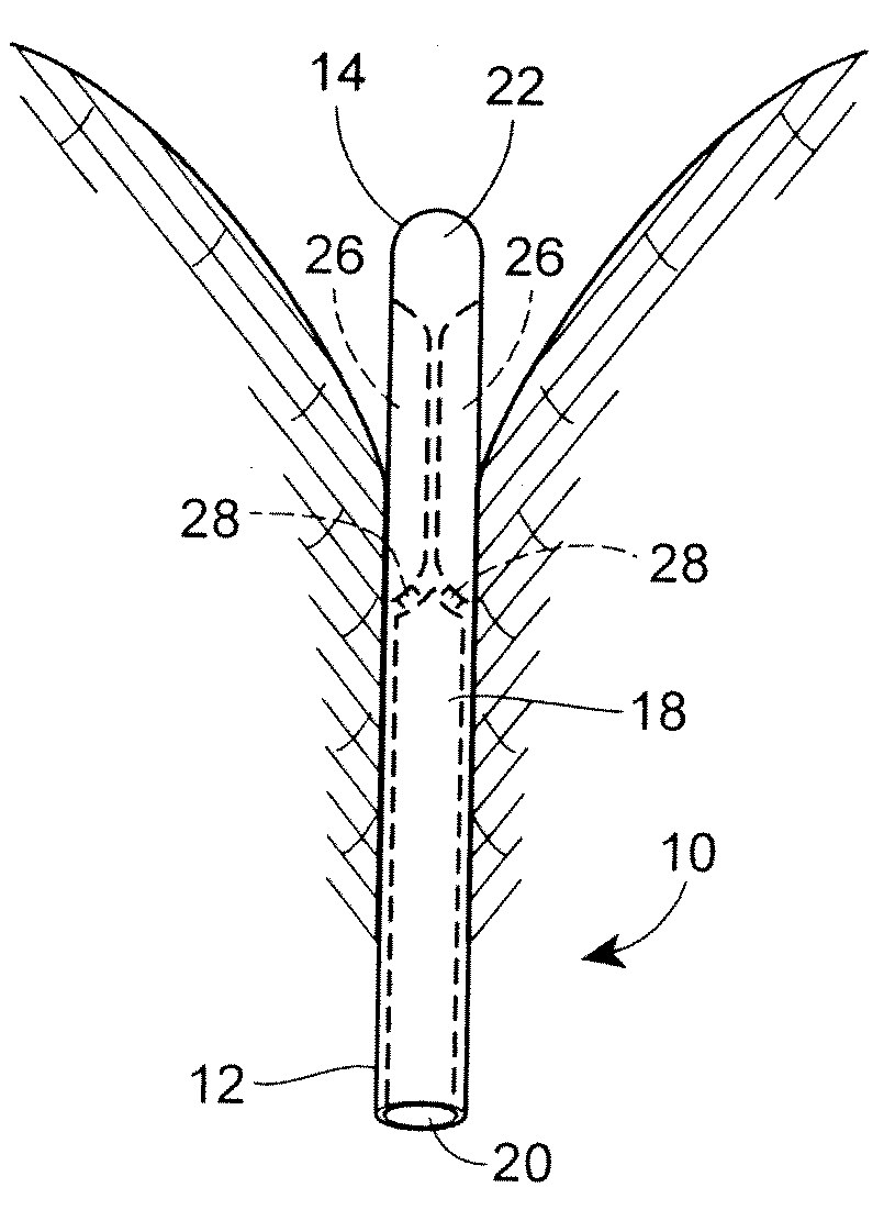 Fluid Drainage Catheter Having an External Flow Path