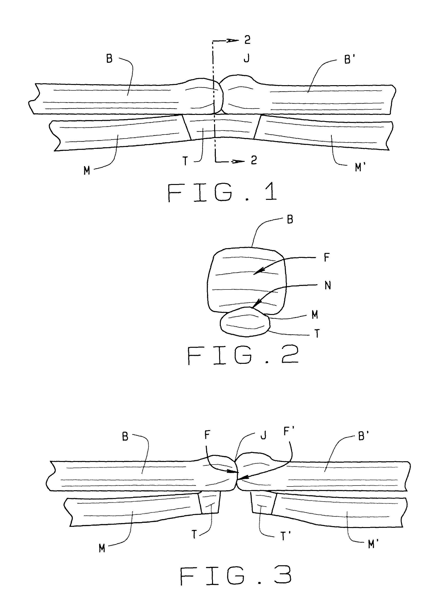 Flexor tendon repair device