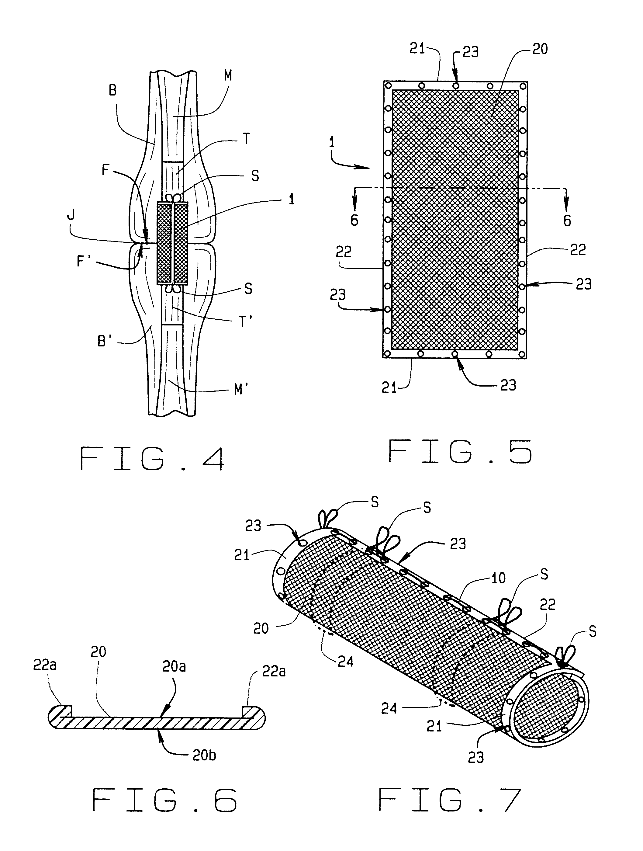 Flexor tendon repair device