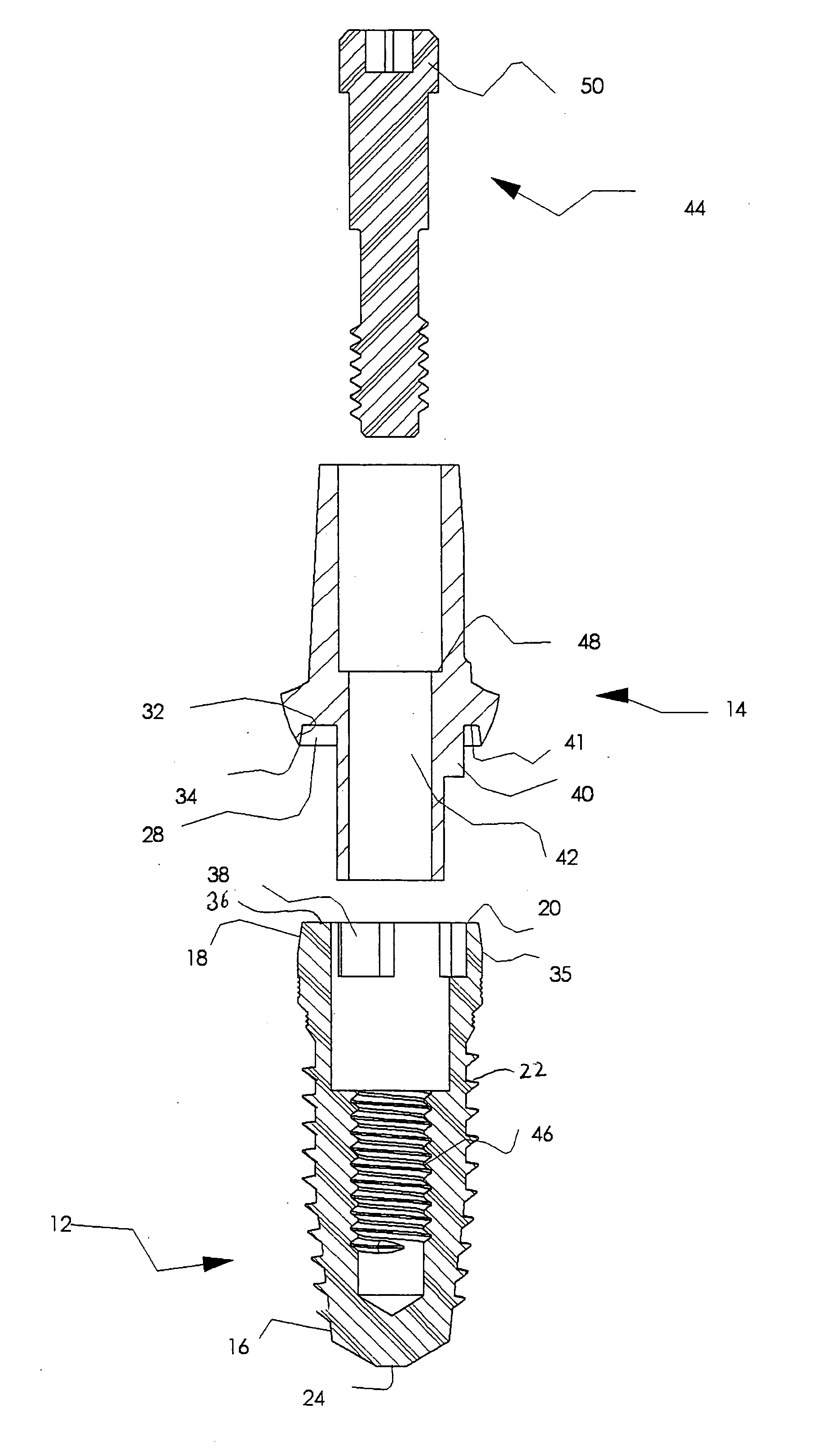 Dental implant system