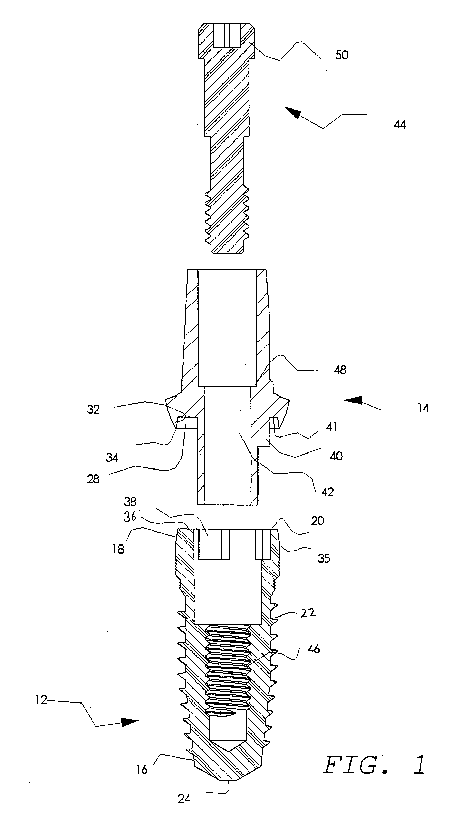 Dental implant system