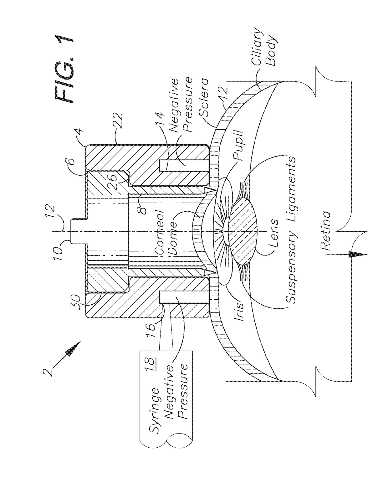 Ophthalmic incisional procedure instrument and method