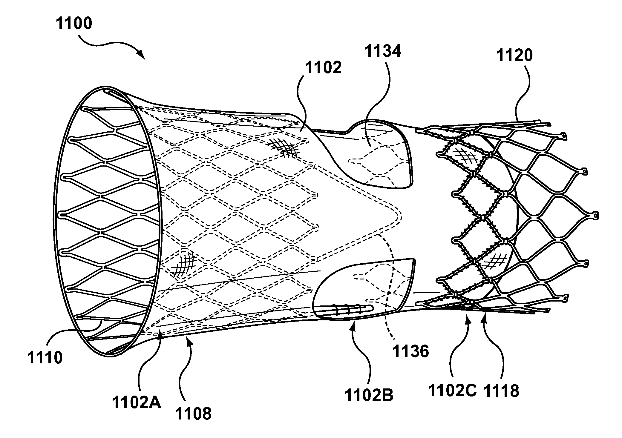 Segmented transcatheter valve prosthesis having an unsupported valve segment