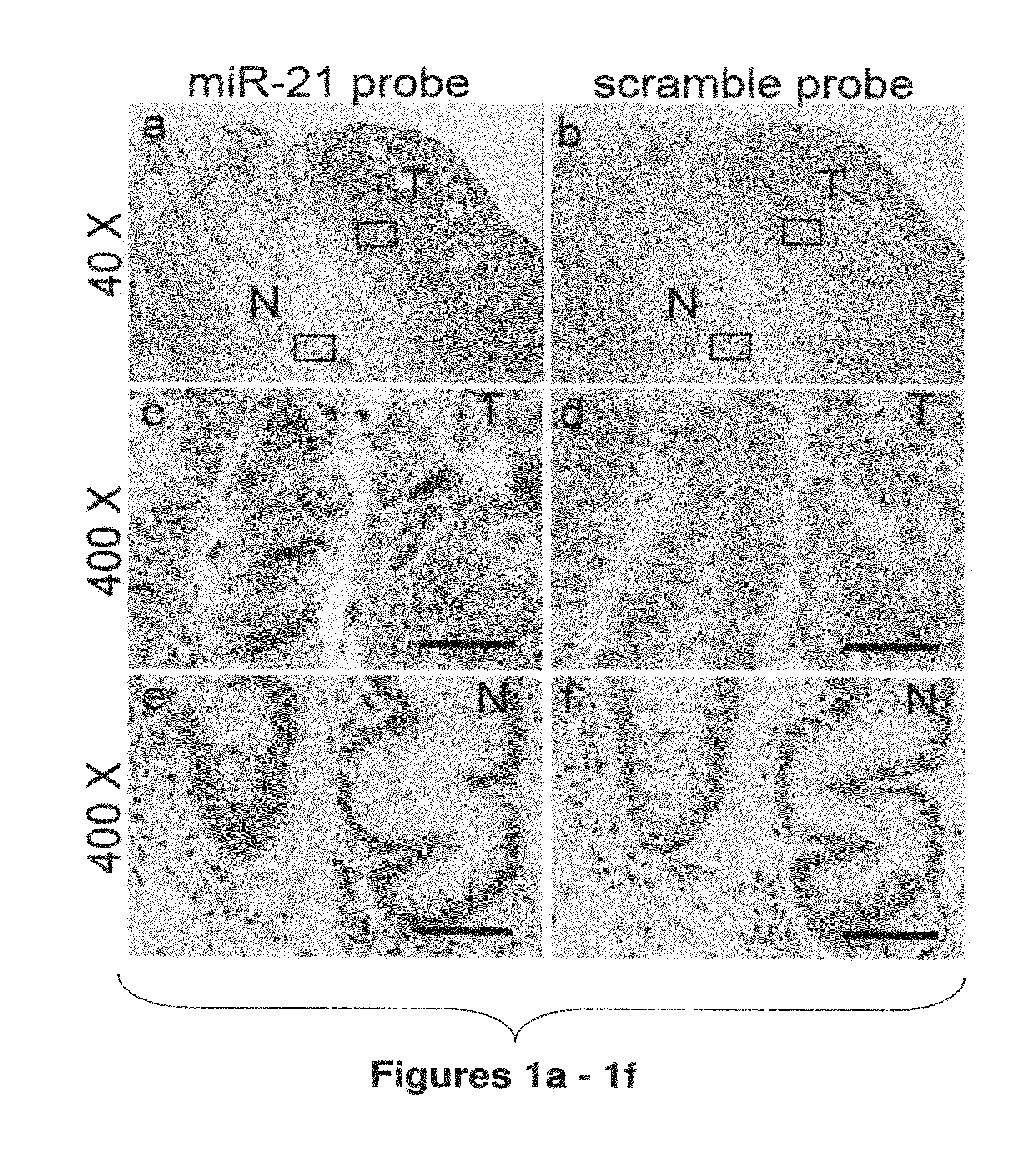 METHOD OF DIAGNOSING POOR SURVIVAL PROGNOSIS COLON CANCER USING let-7g