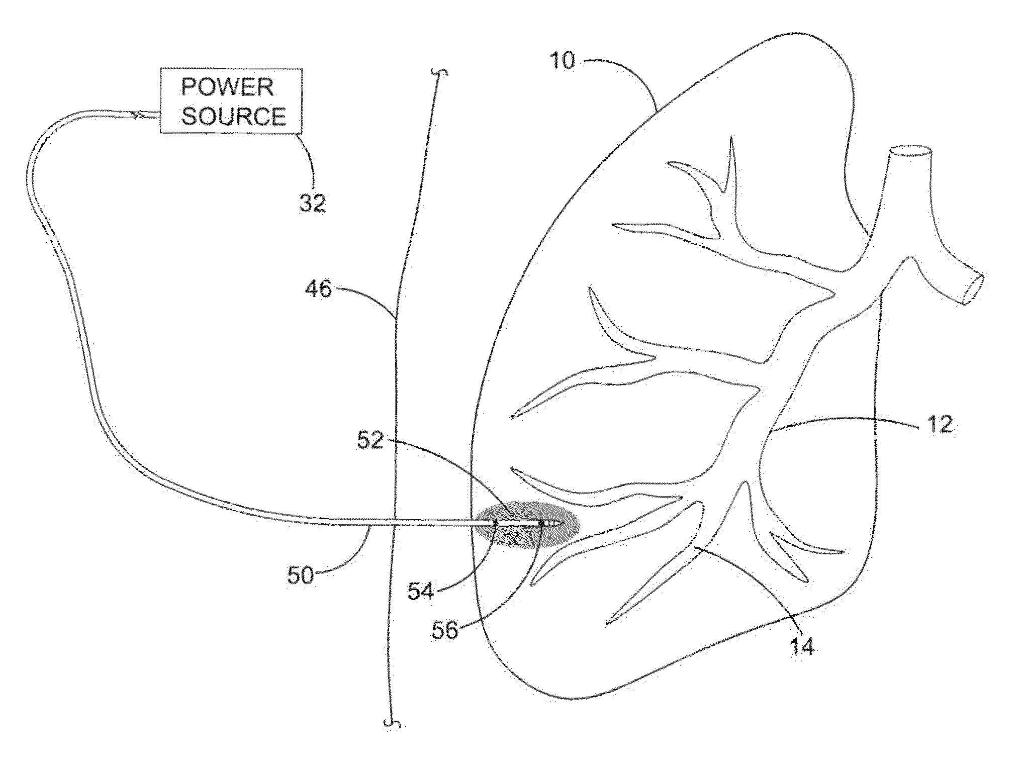 Irreversible electroporation (IRE) for congestive obstructive pulmonary disease (COPD)