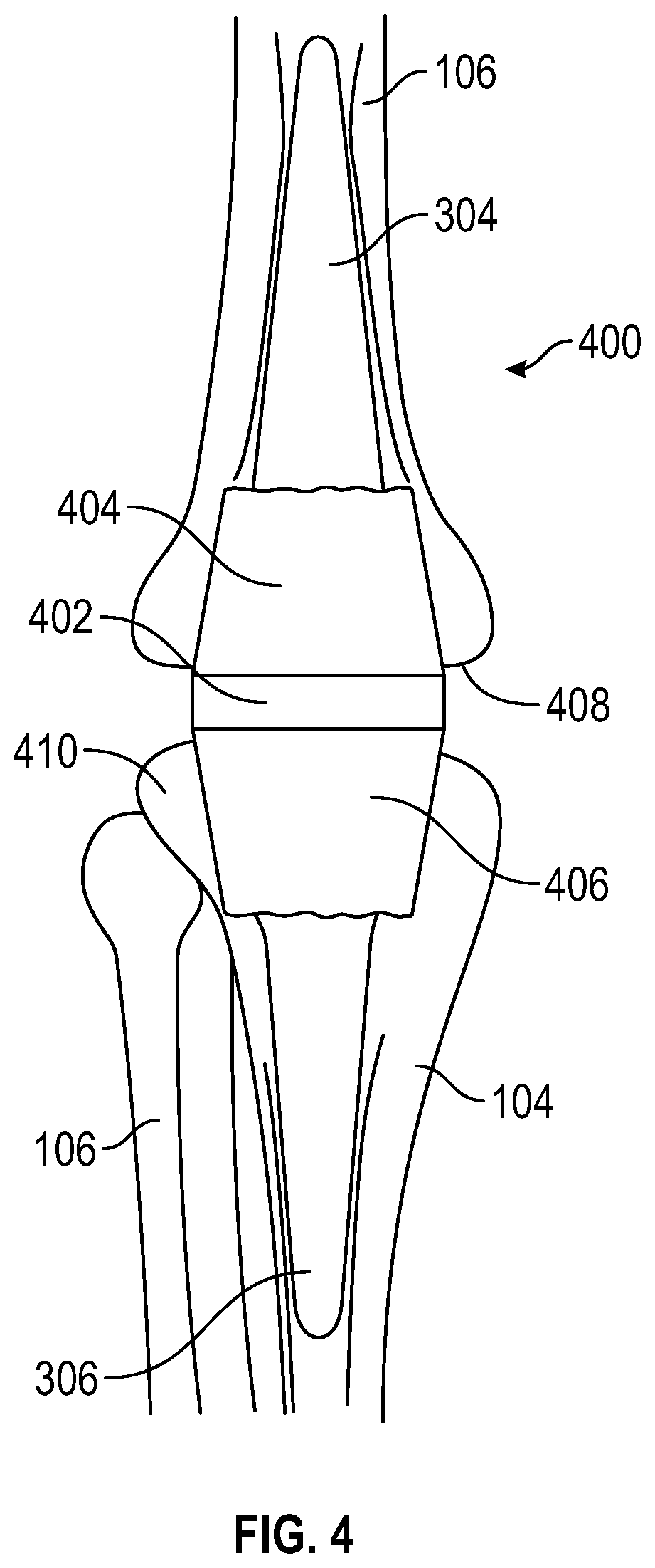 Implantable Knee Prosthesis with Integrated Prosthetic Extensor Mechanism.