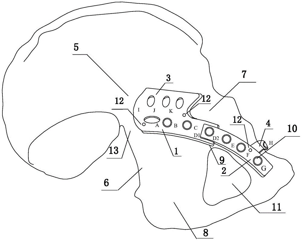 Fixing device and method for fractures of anterior and posterior columns of acetabulum