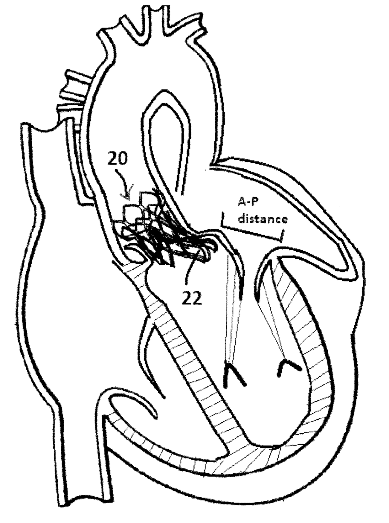 Method and Design for a Mitral Regurgitation Treatment Device