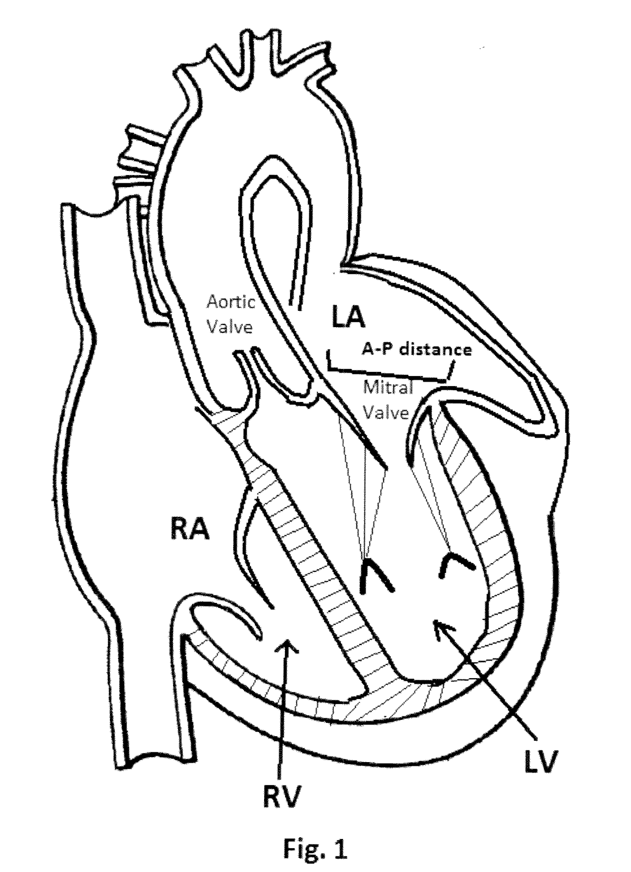 Method and Design for a Mitral Regurgitation Treatment Device