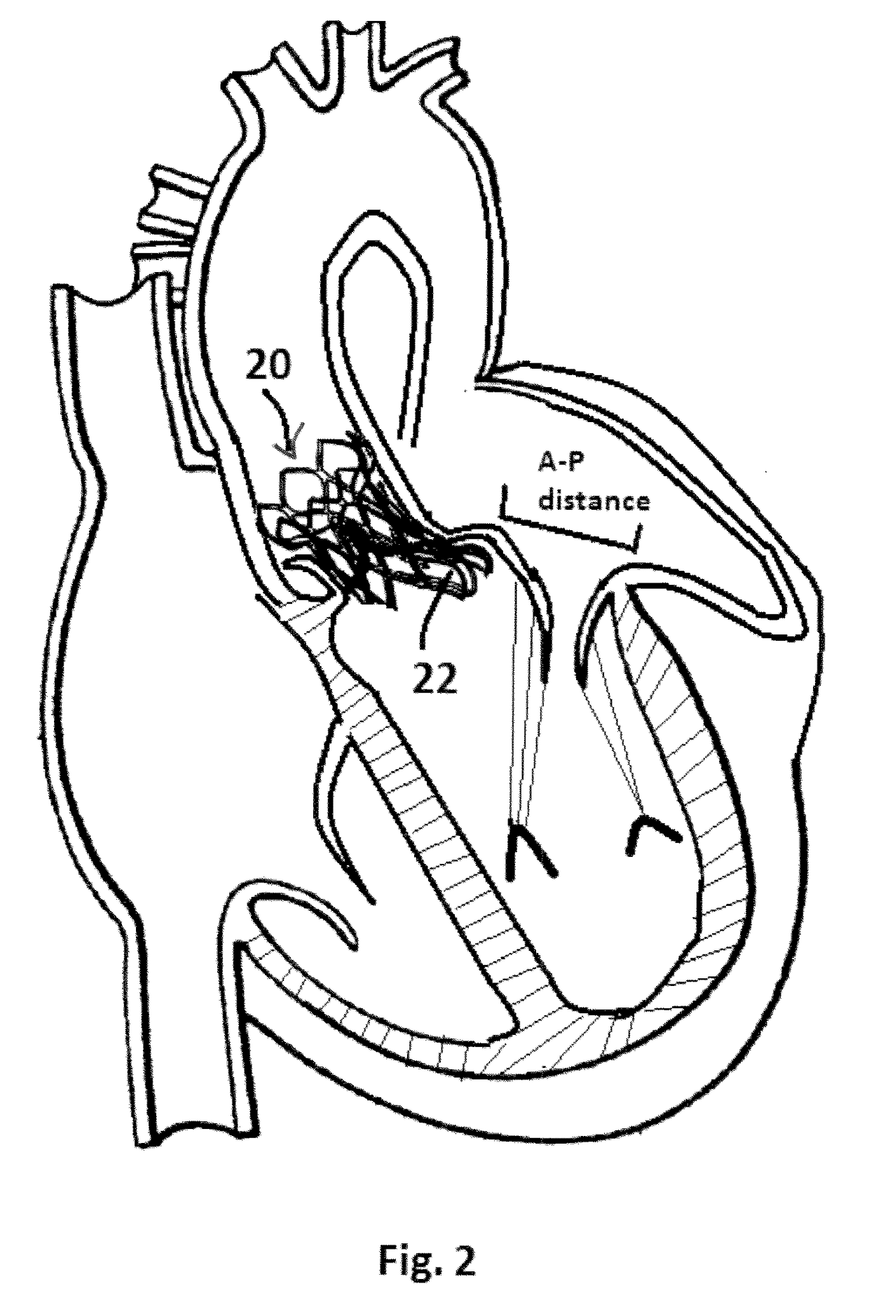 Method and Design for a Mitral Regurgitation Treatment Device