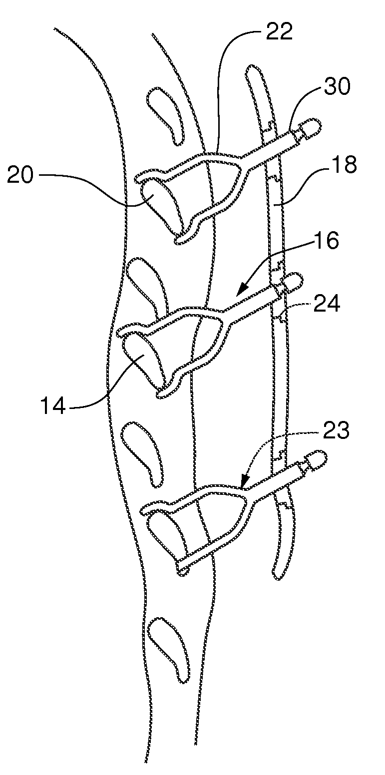 Device for treating flail chest