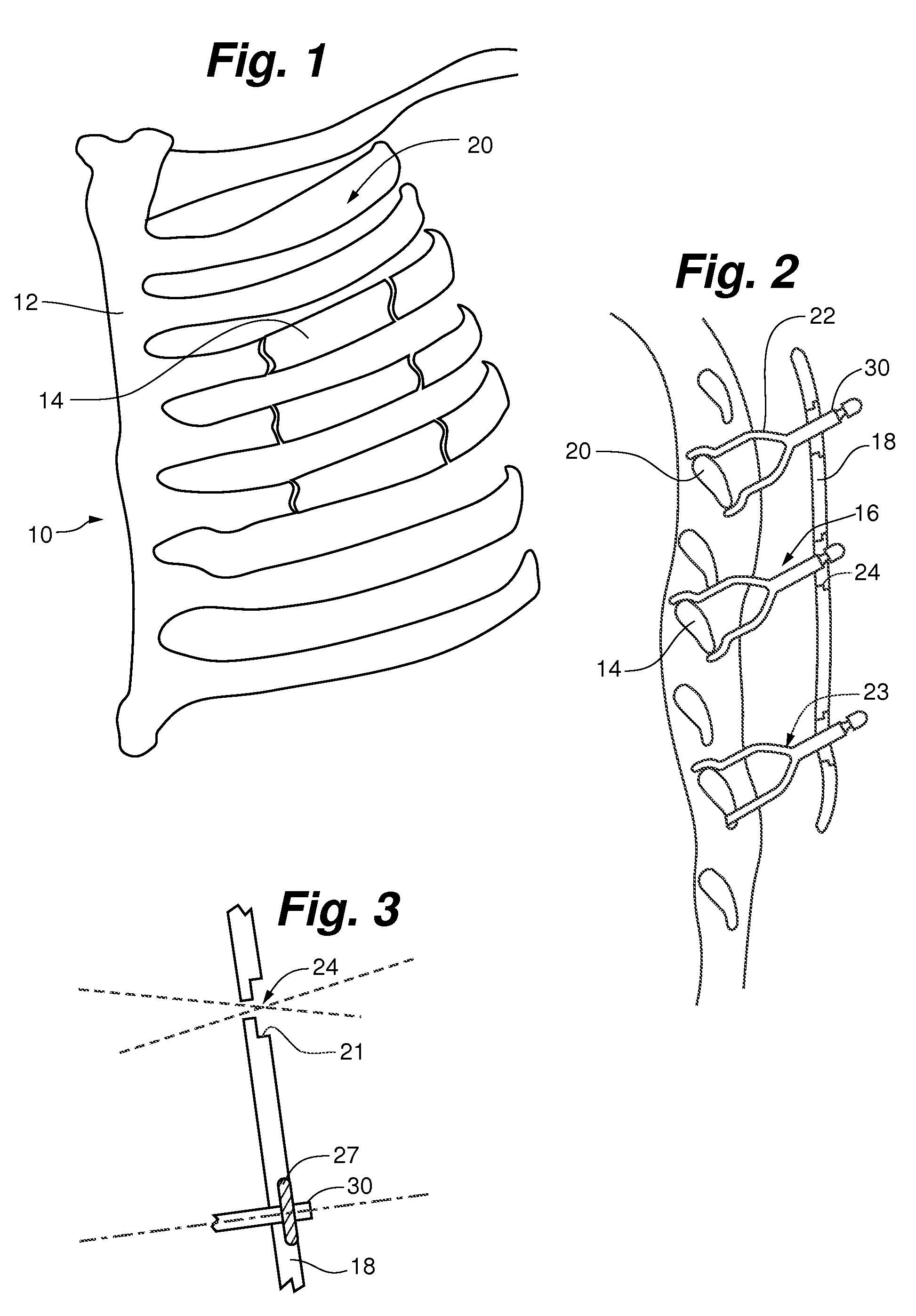 Device for treating flail chest