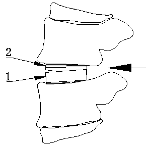 Posterior lumbar interbody fusion device and using method