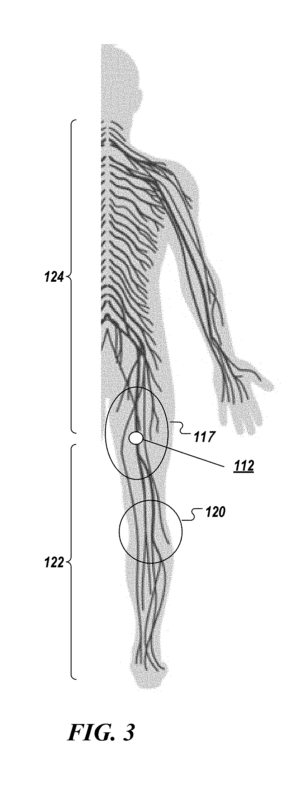 System and method to percutaneously block painful sensations