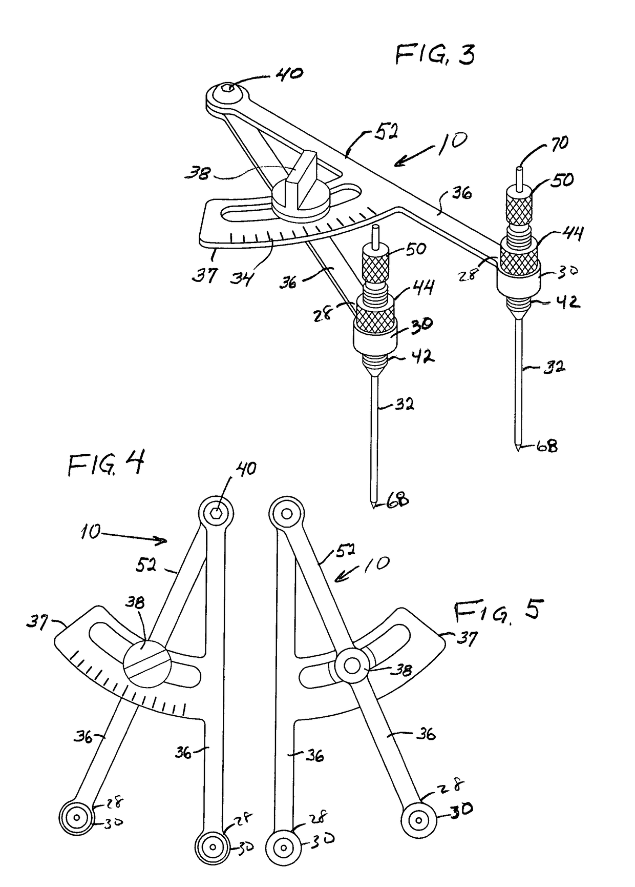 Extracapsular surgical procedure