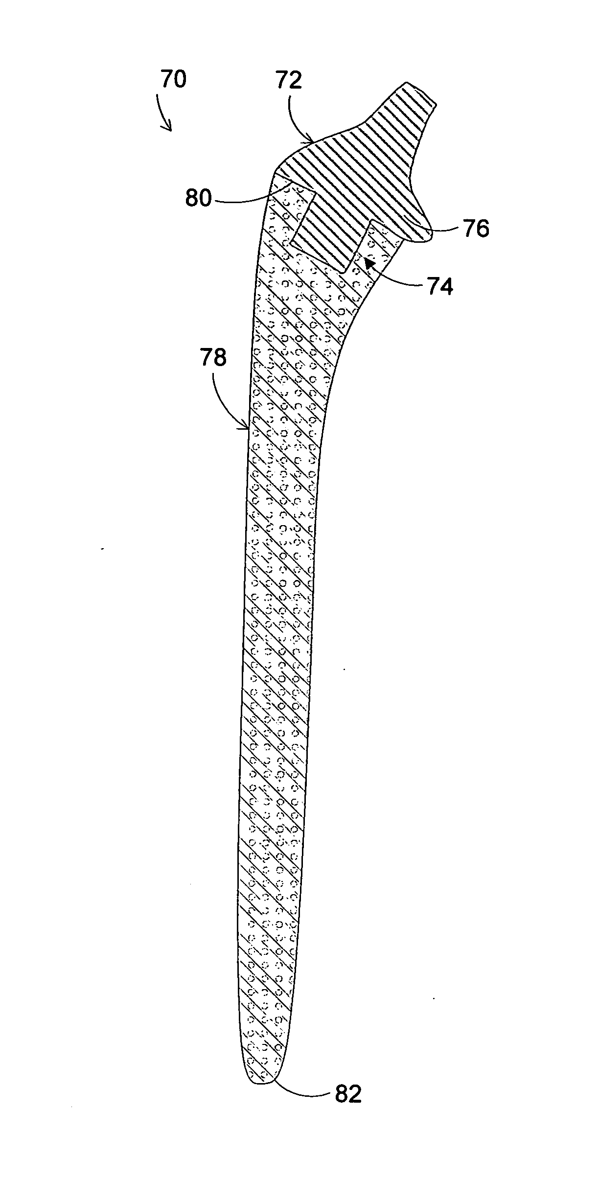 Hip implant with porous body