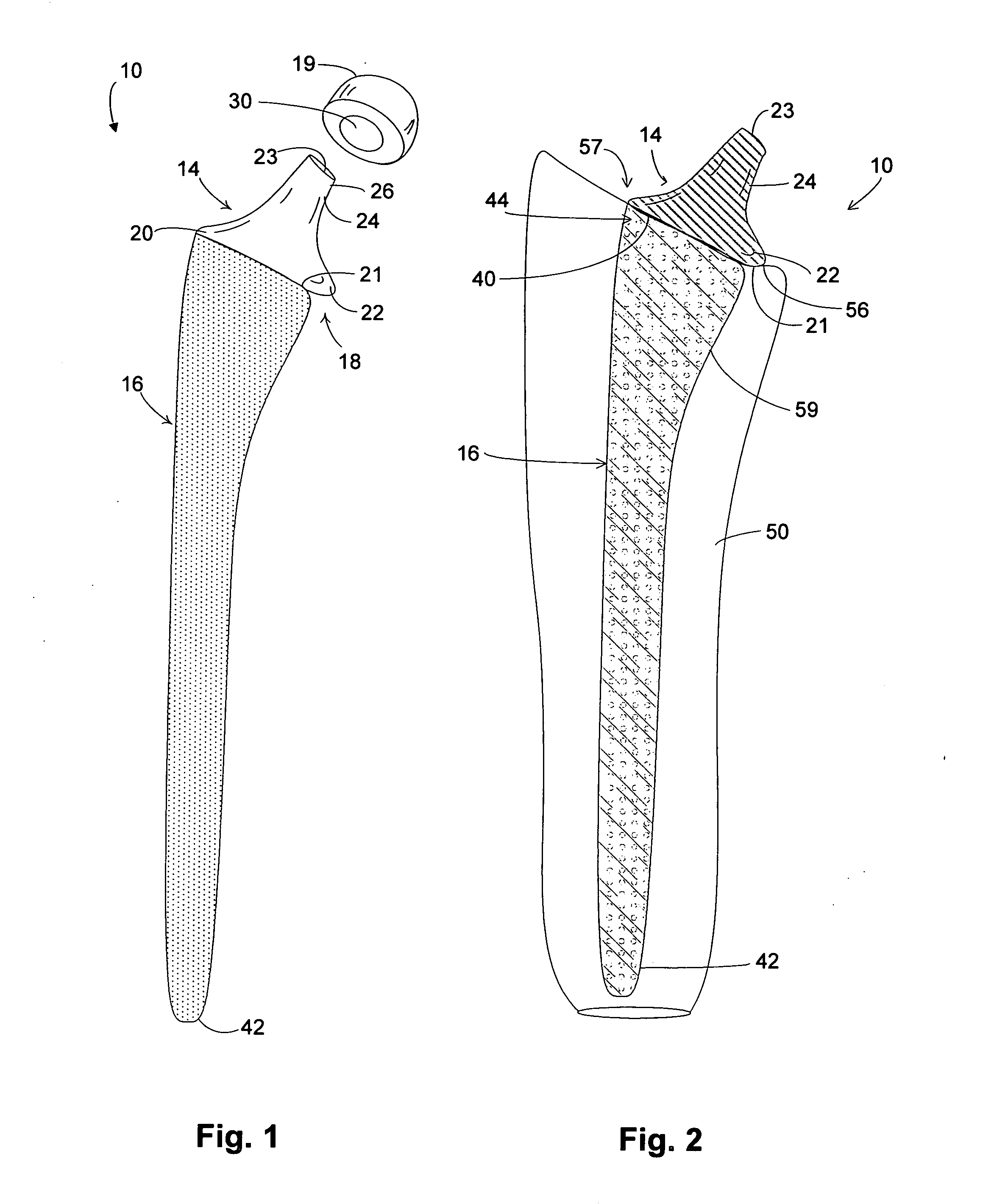 Hip implant with porous body