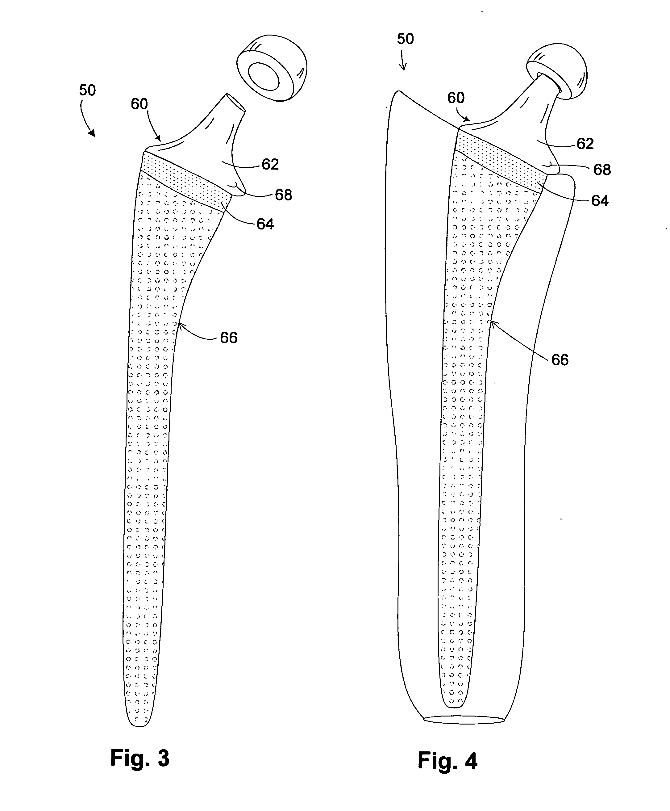 Hip implant with porous body