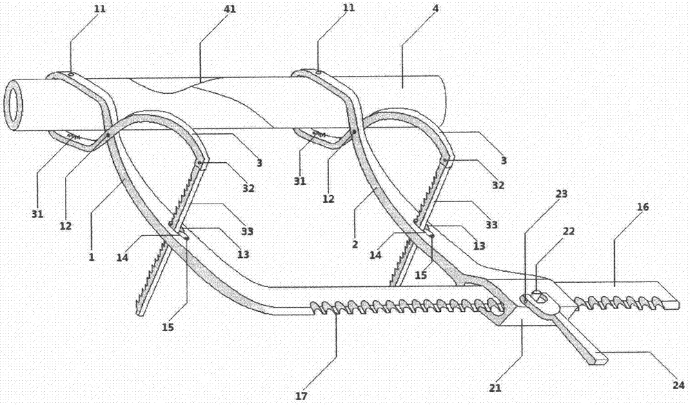 Bone fracture distraction restoration fixing forceps