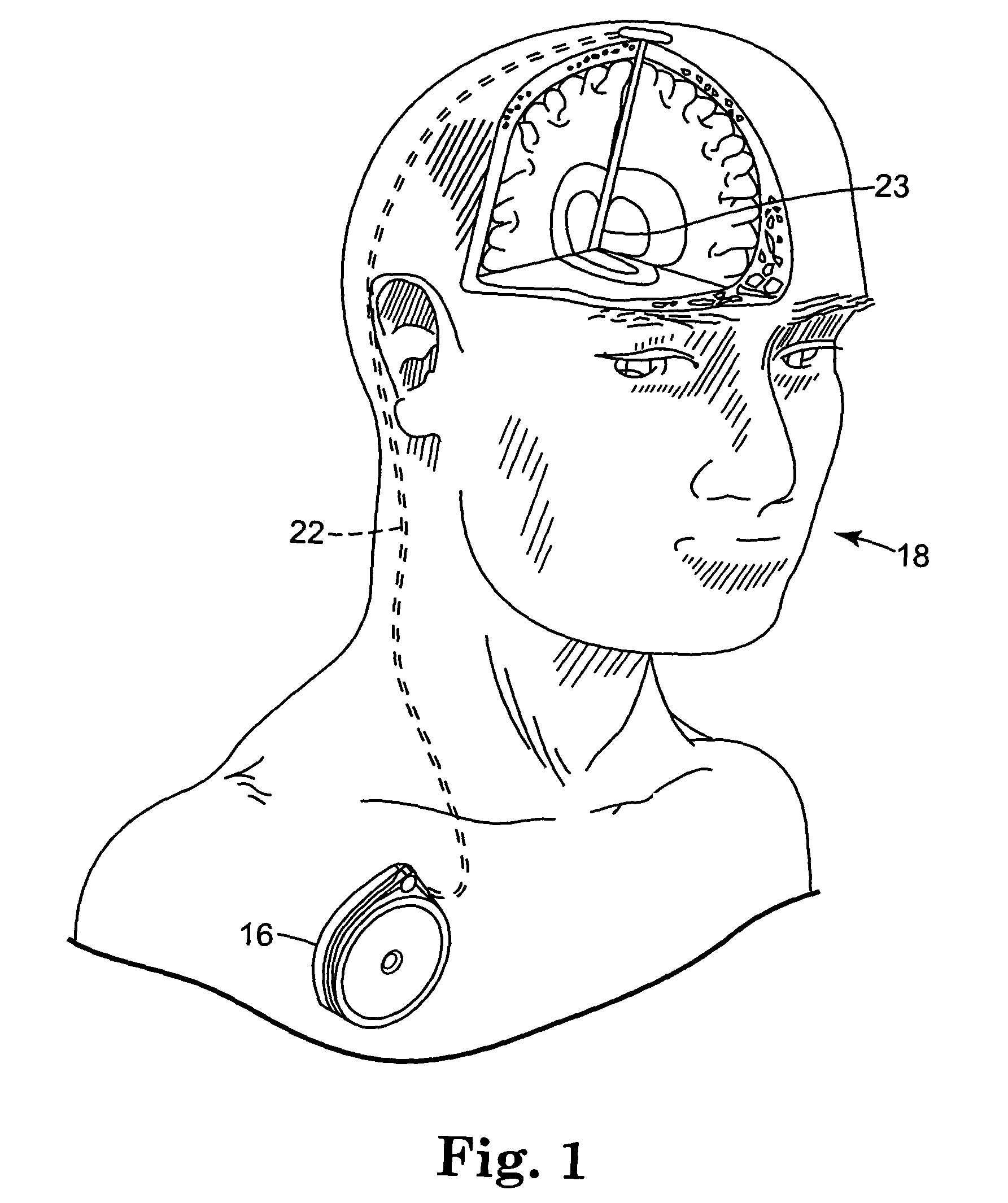 External power source for an implantable medical device having an adjustable carrier frequency and system and method related therefore