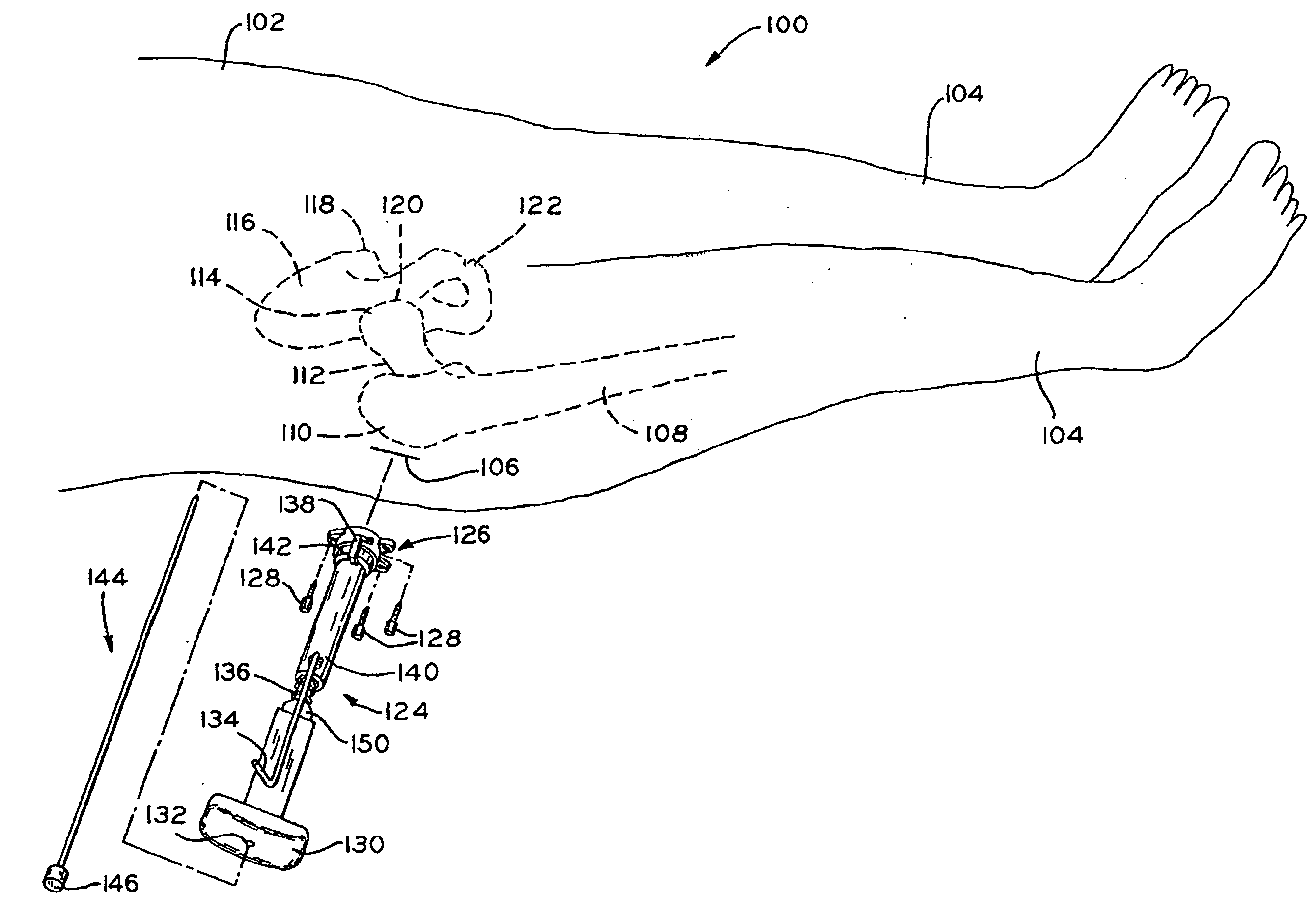 Method and apparatus for reducing femoral fractures