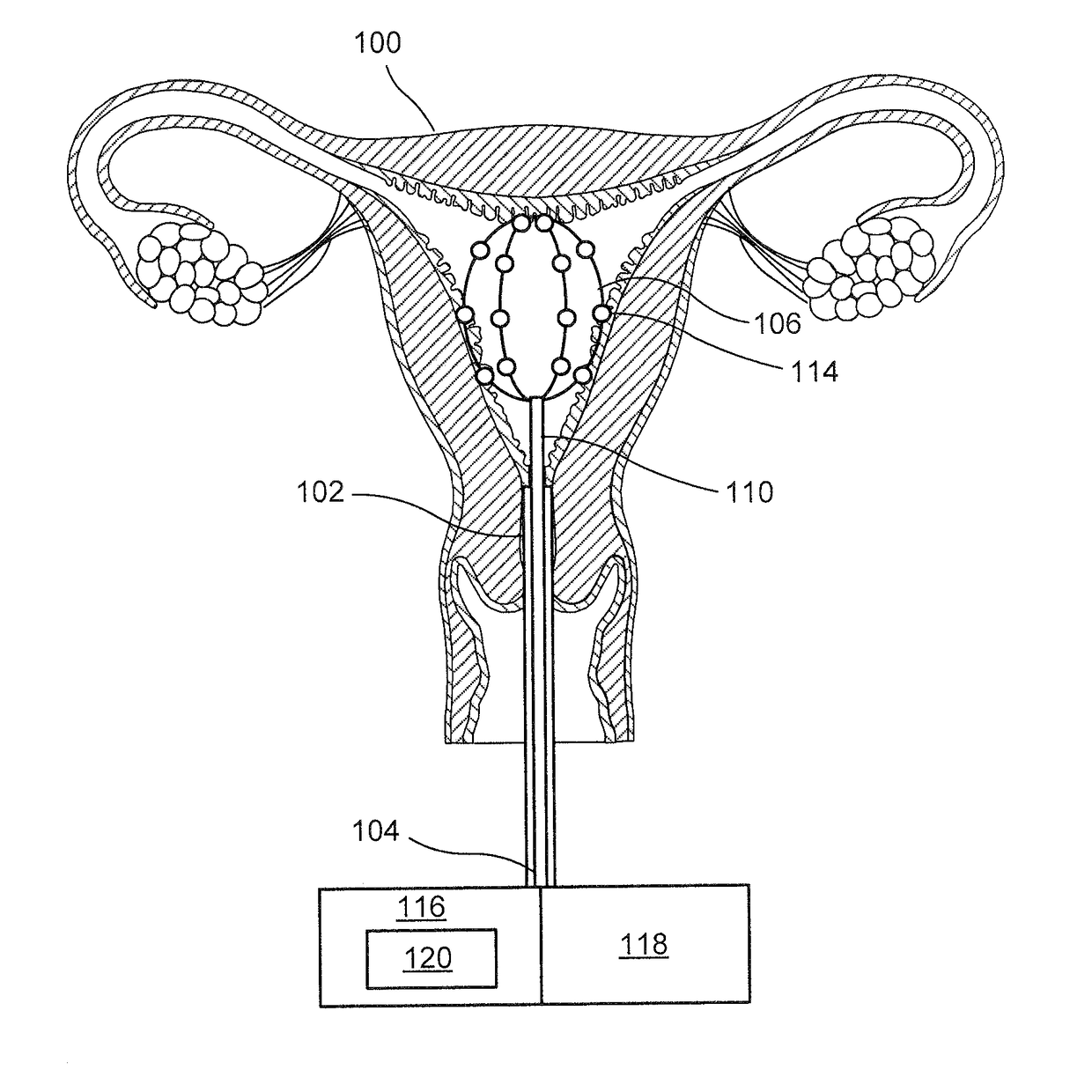 Solutions For Early Diagnoses, Prevention And Treatment Of Endometriosis