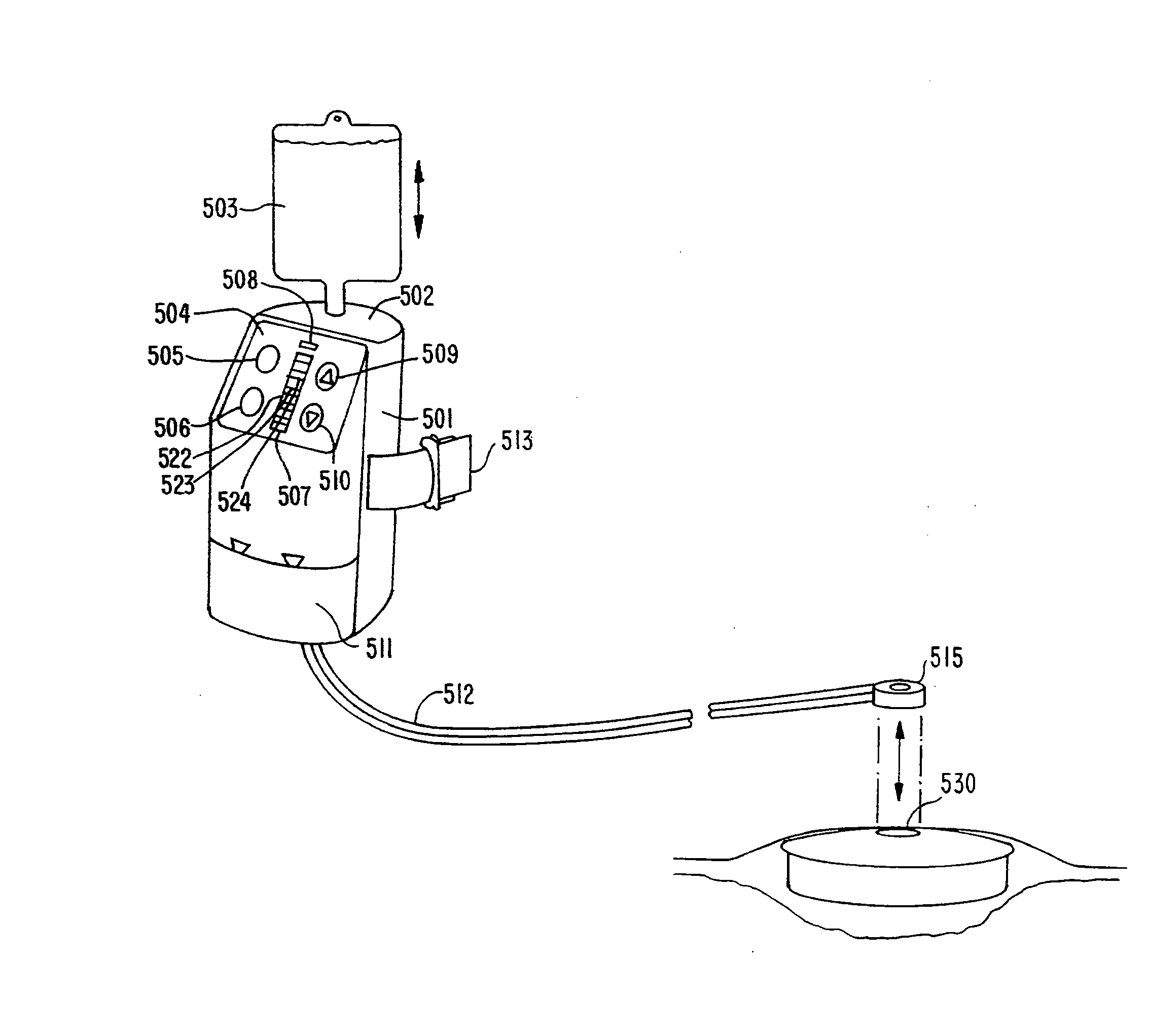 Wound Irrigation Device