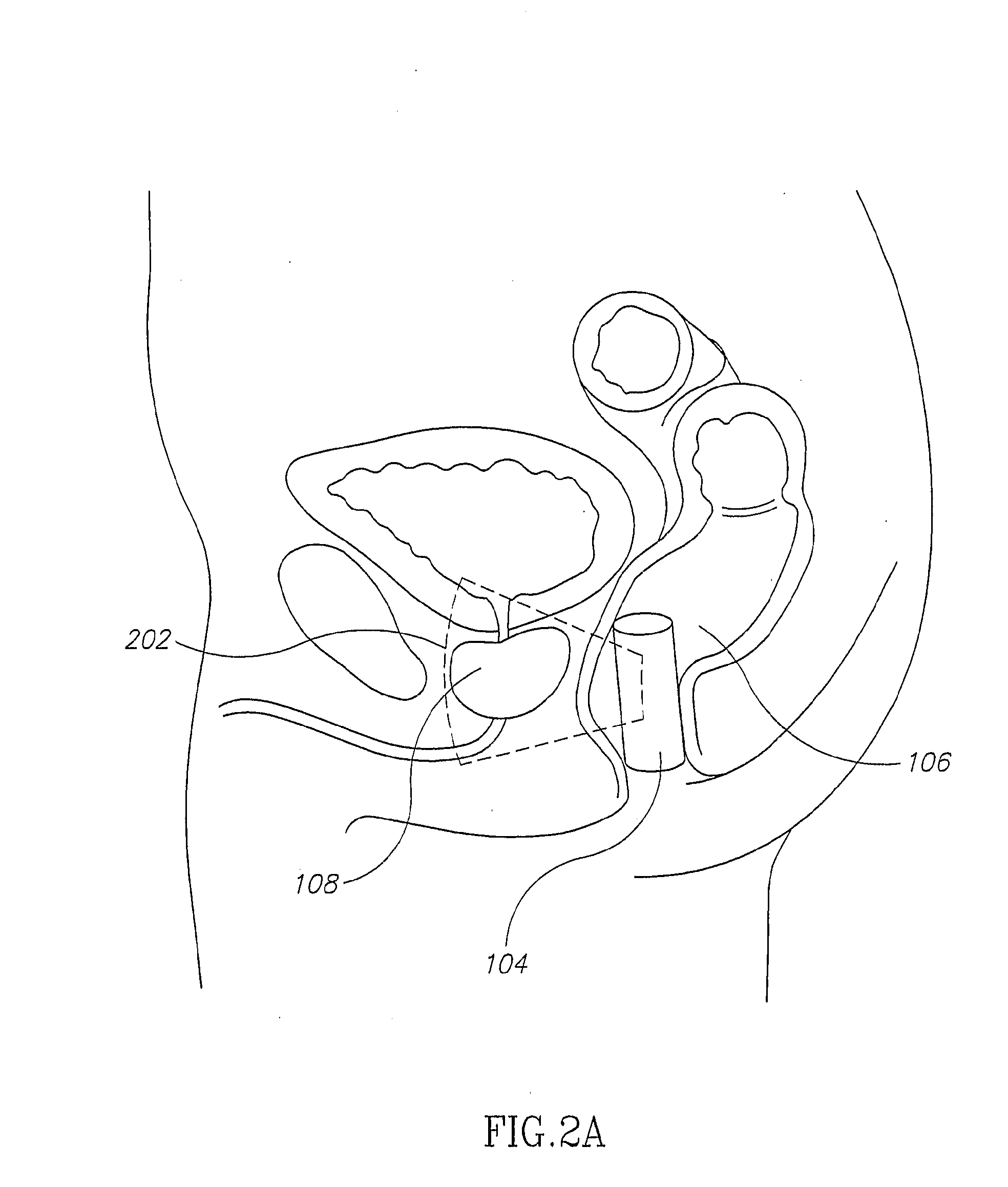 Mri Probe for Prostate Imaging