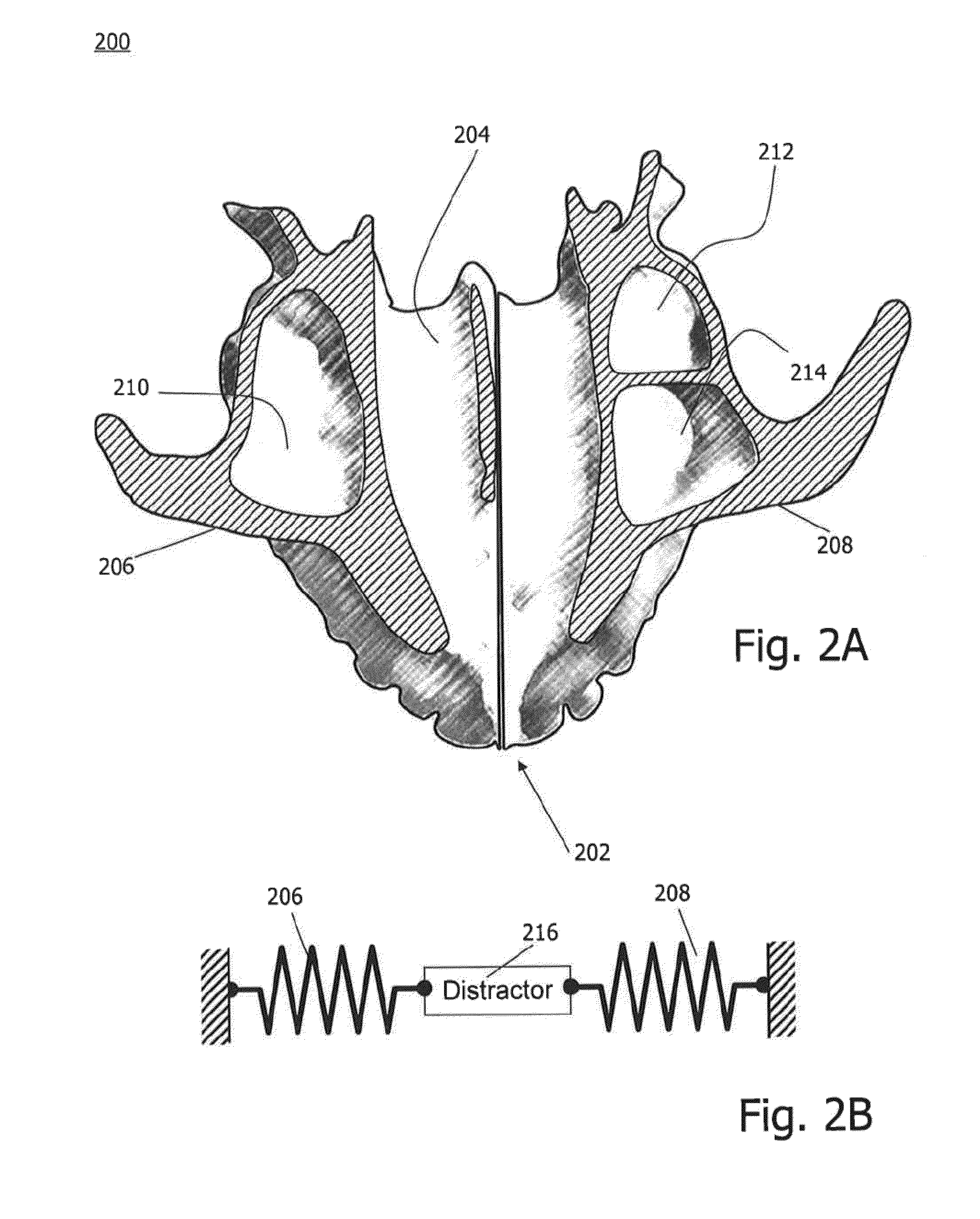 Computer-implemented technique for defining a bone cut