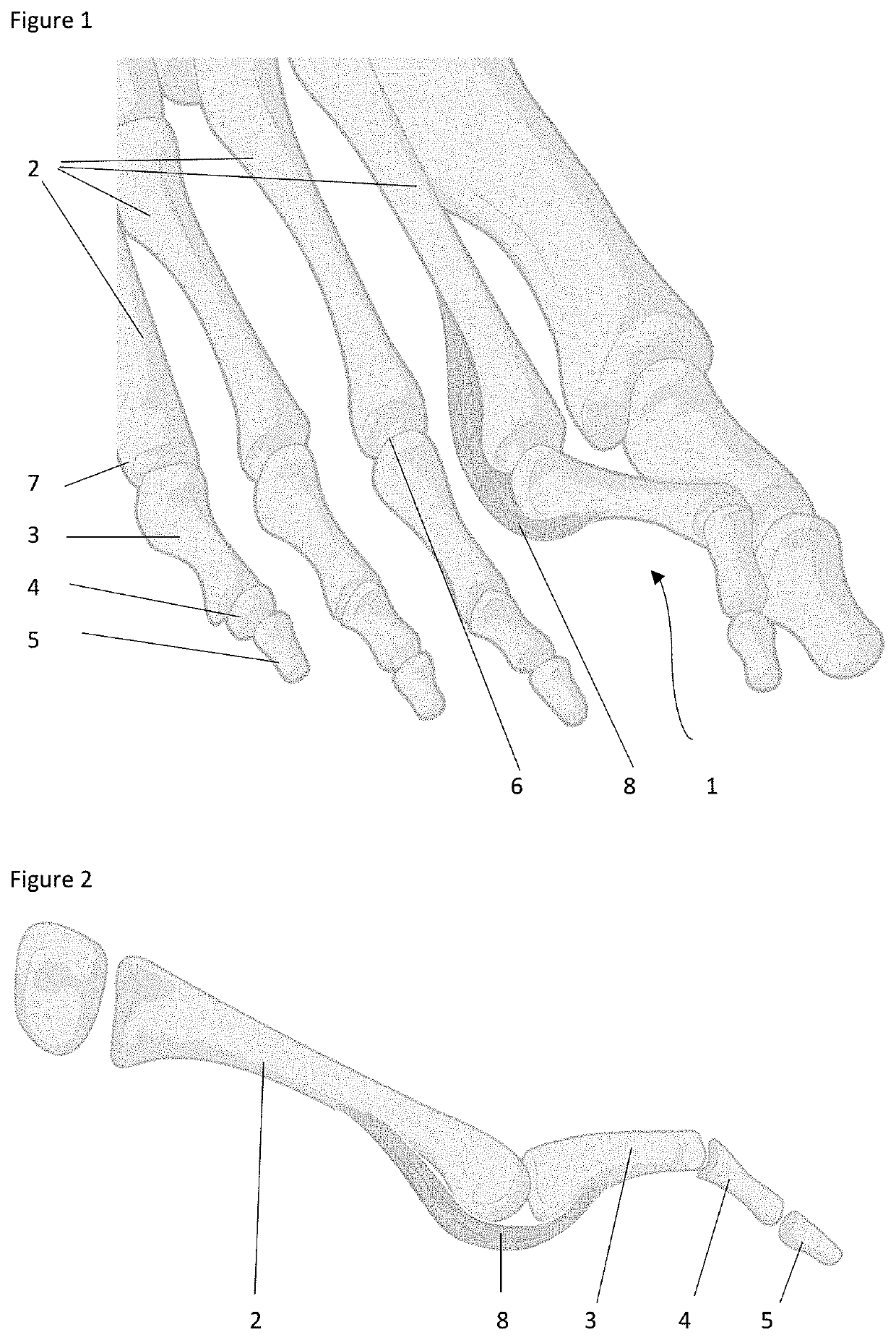 Novel surgical methods for the treatment of plantar plate injury