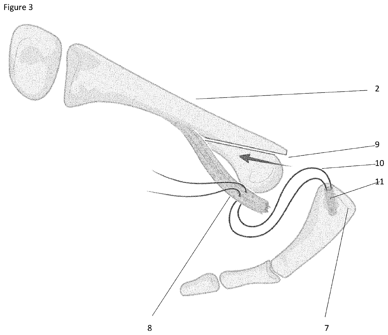 Novel surgical methods for the treatment of plantar plate injury