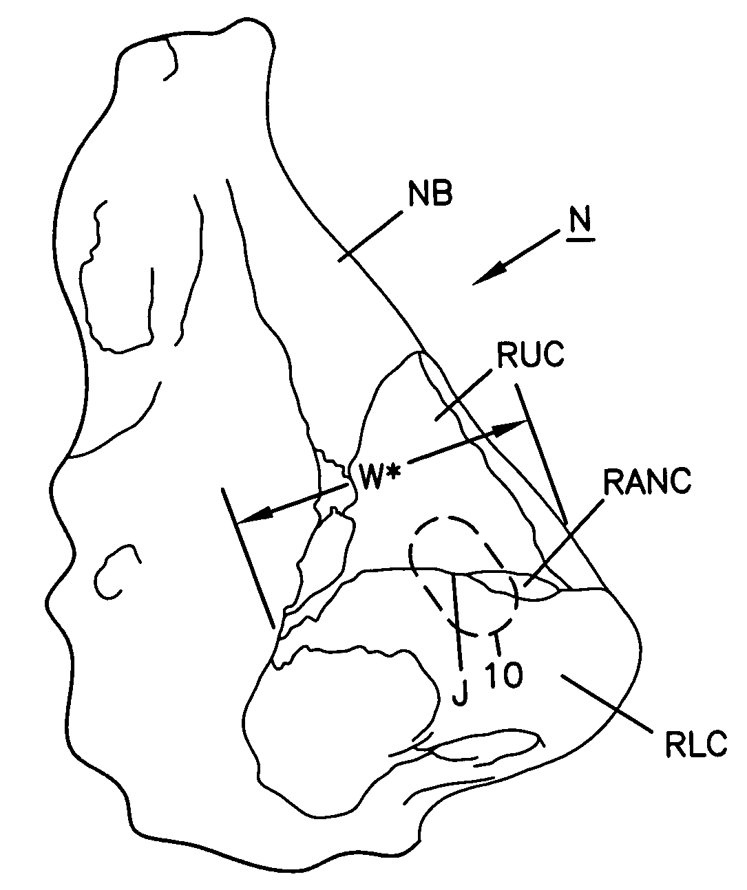 Nasal valve treatment method and apparatus