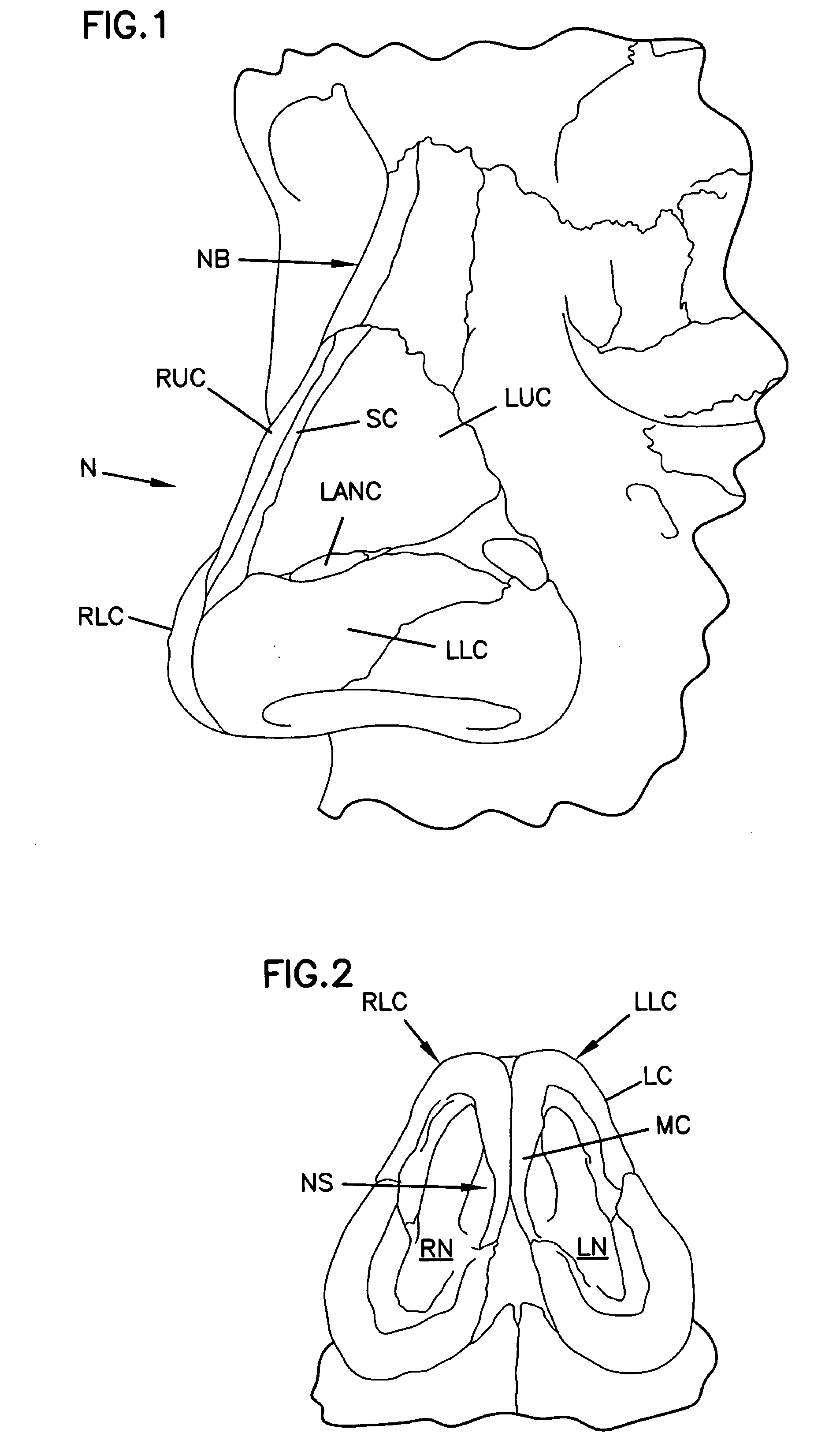 Nasal valve treatment method and apparatus