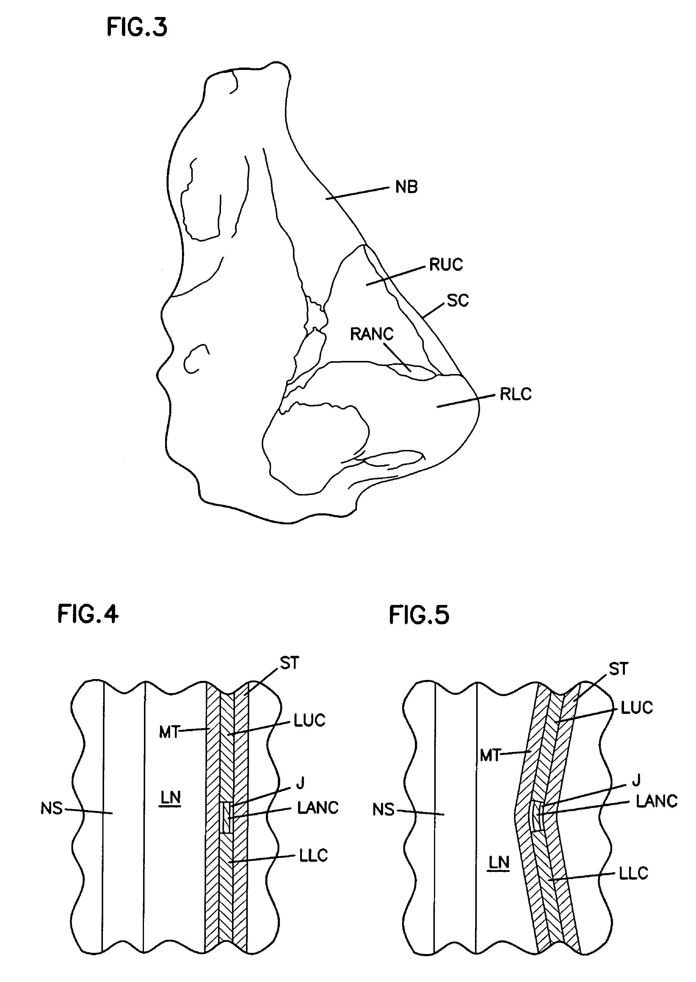 Nasal valve treatment method and apparatus