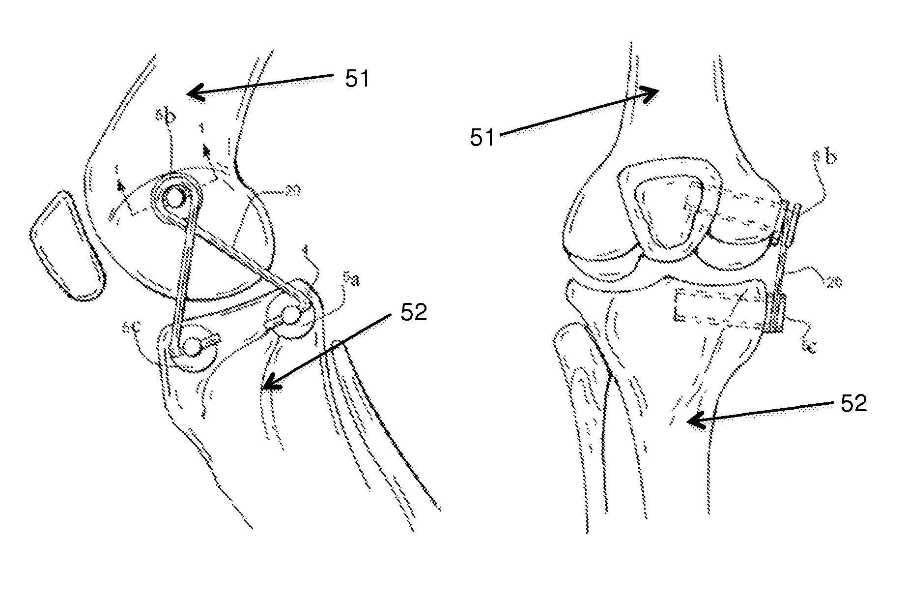 Internal joint bracing system and suture anchoring assembly therefore