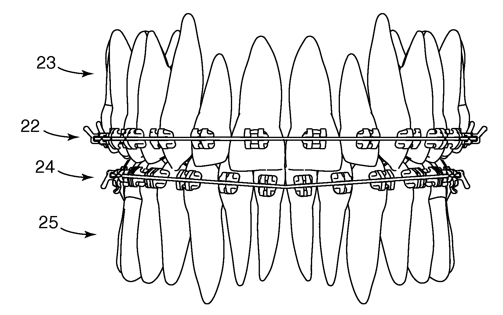 Orthodontic articles with zirconium oxide coatings