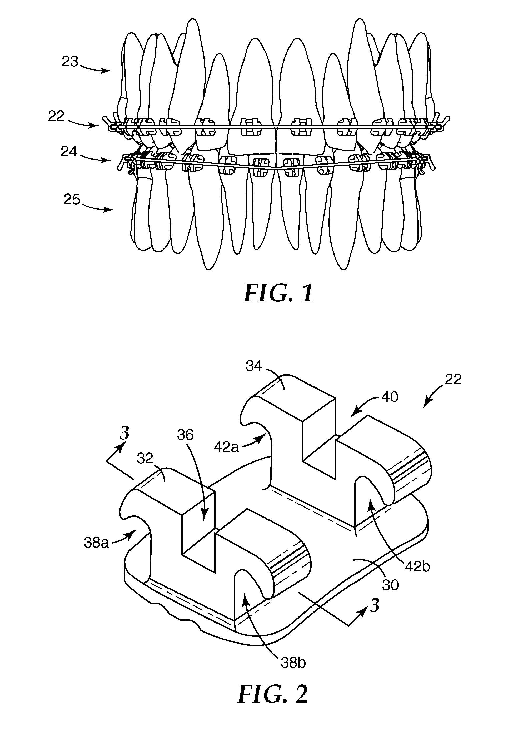 Orthodontic articles with zirconium oxide coatings