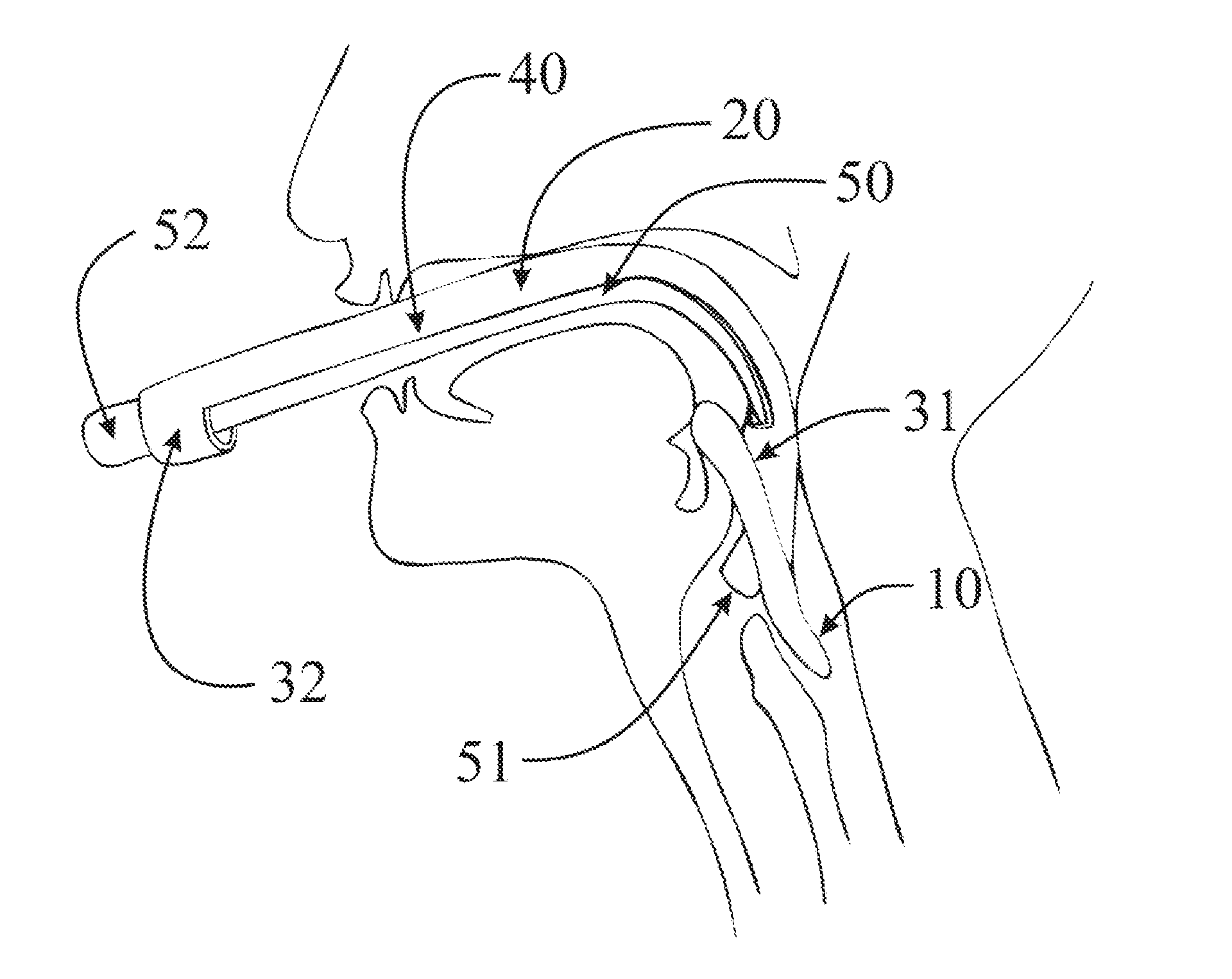 Endotracheal Tube Insertion Device