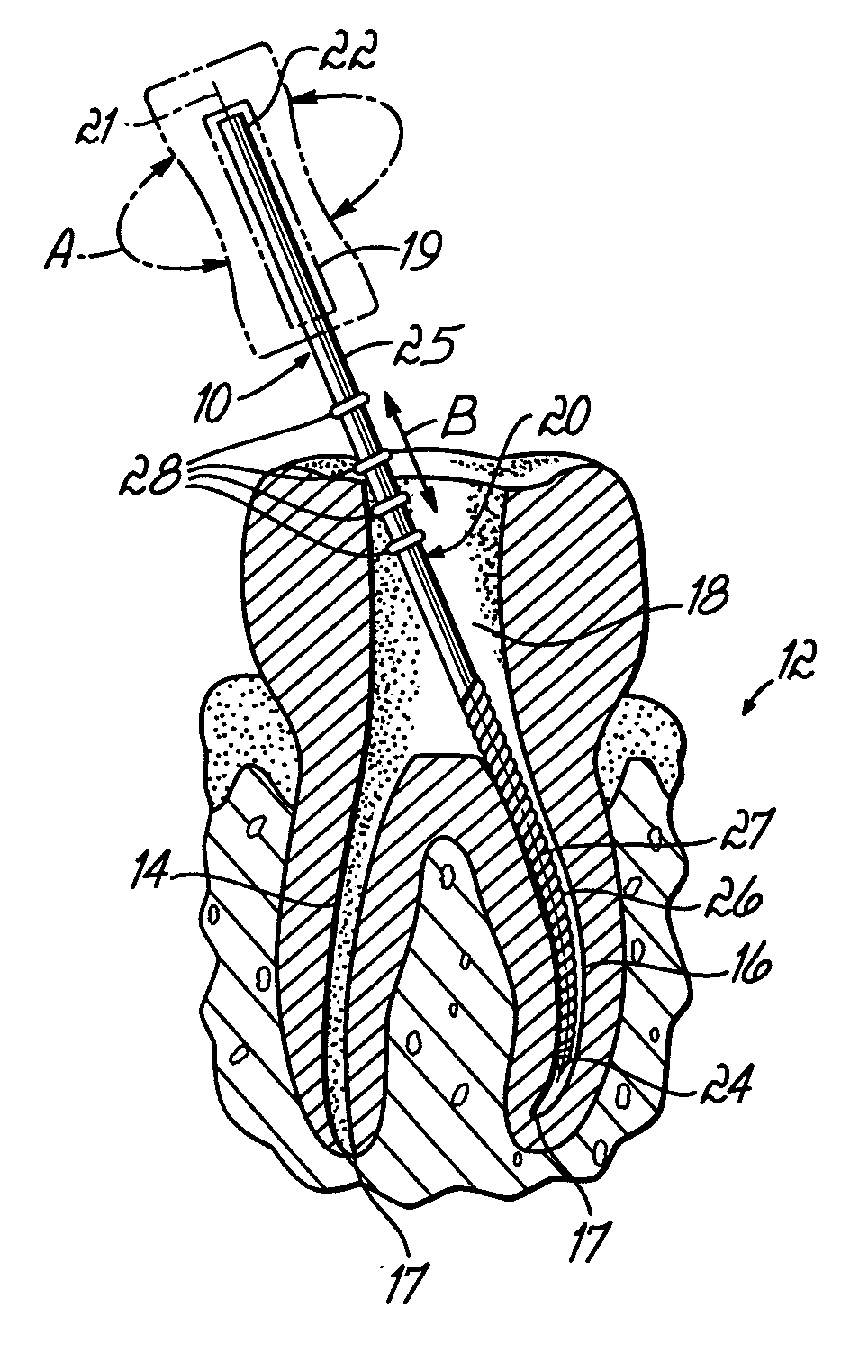 Endodontic instrument with depth markers