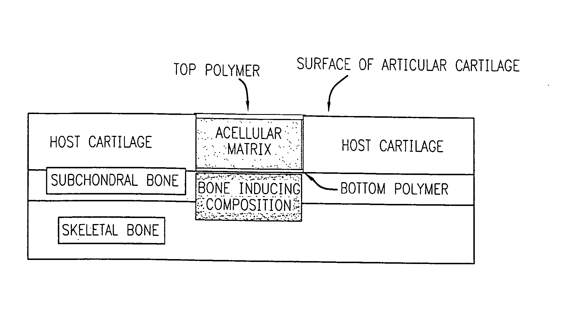 Acellular matrix implanted into an articular cartilage or osteochondral lesion protected with a biodegradable polymer modified to have extended polymerization time and methods for preparation and use thereof