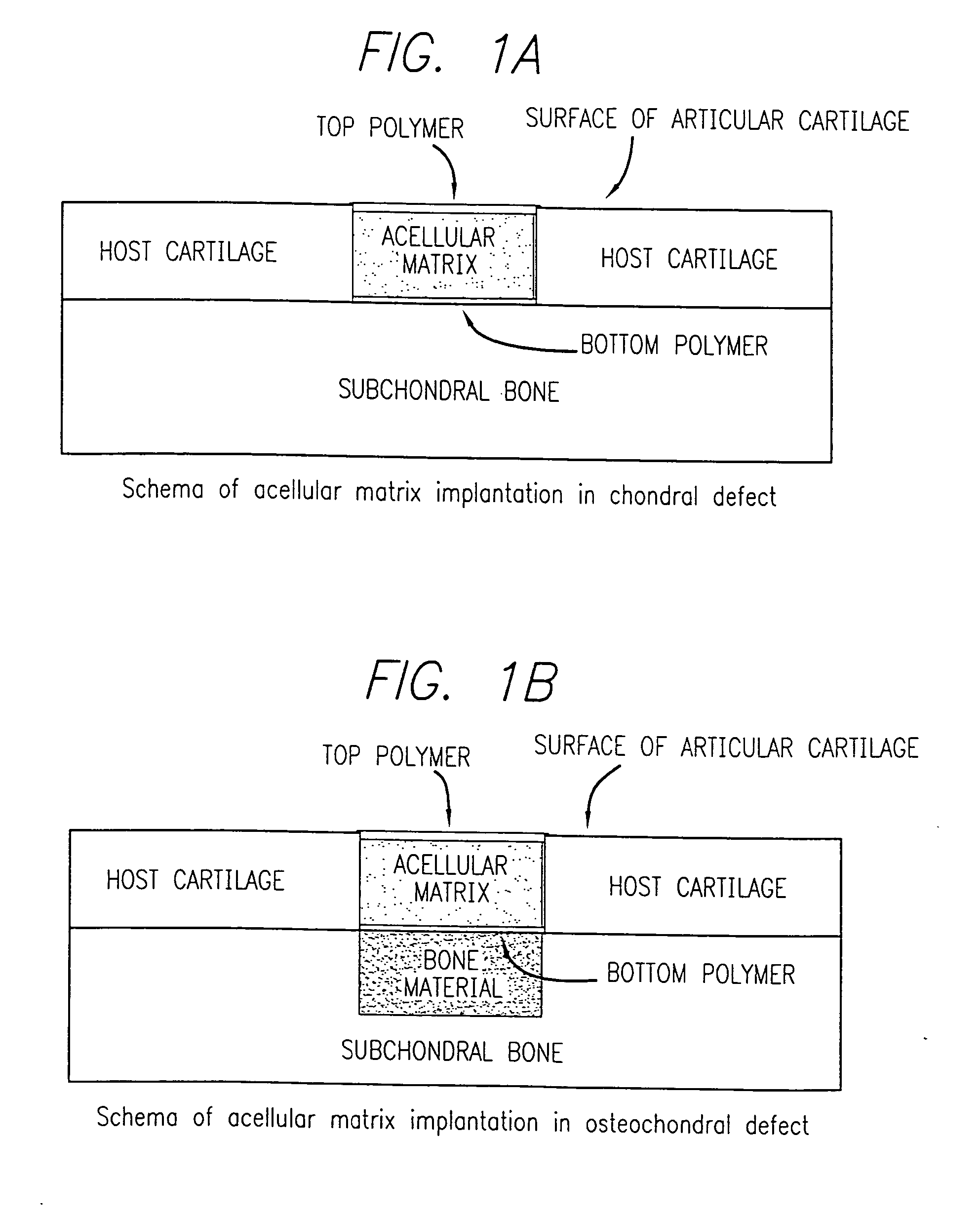 Acellular matrix implanted into an articular cartilage or osteochondral lesion protected with a biodegradable polymer modified to have extended polymerization time and methods for preparation and use thereof