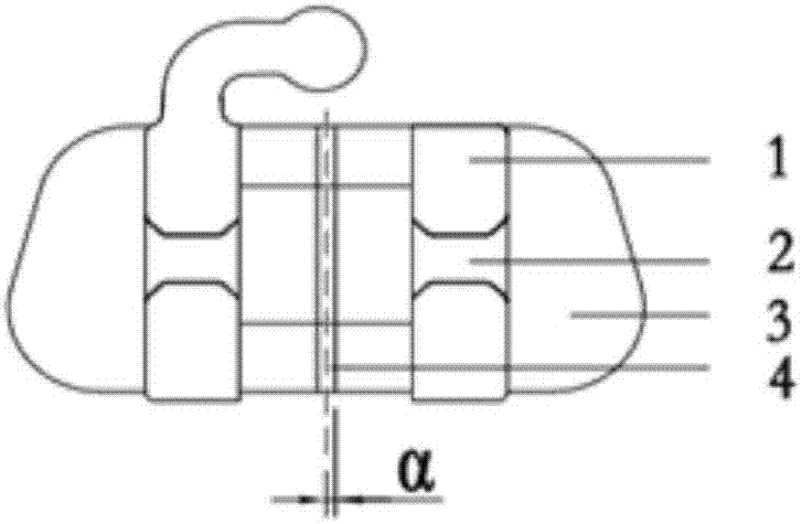 Wx series bracket and buccal tube