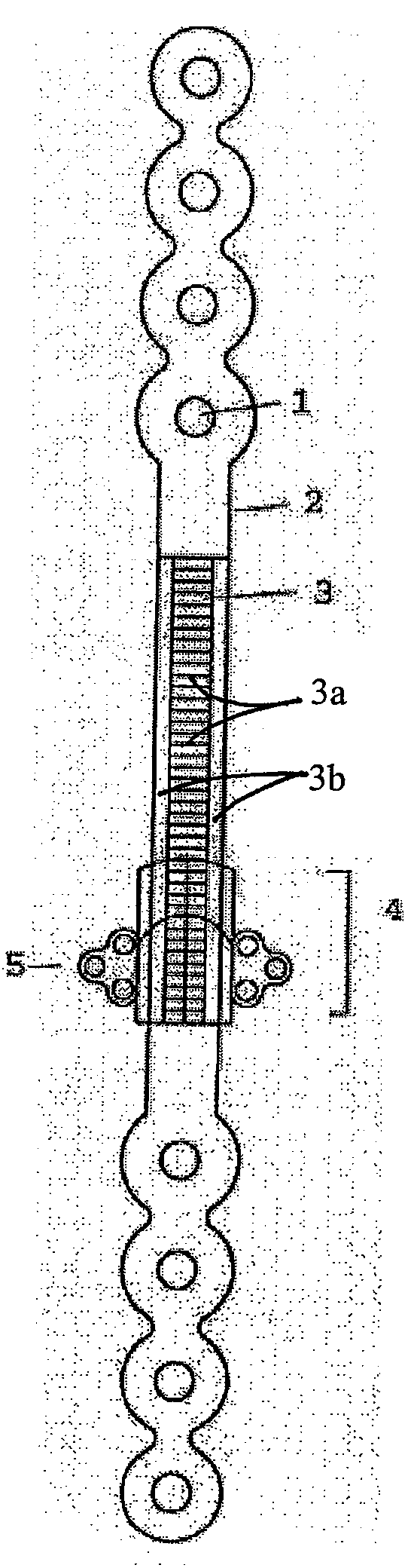 Mandibular Bone Transport Reconstruction Plate