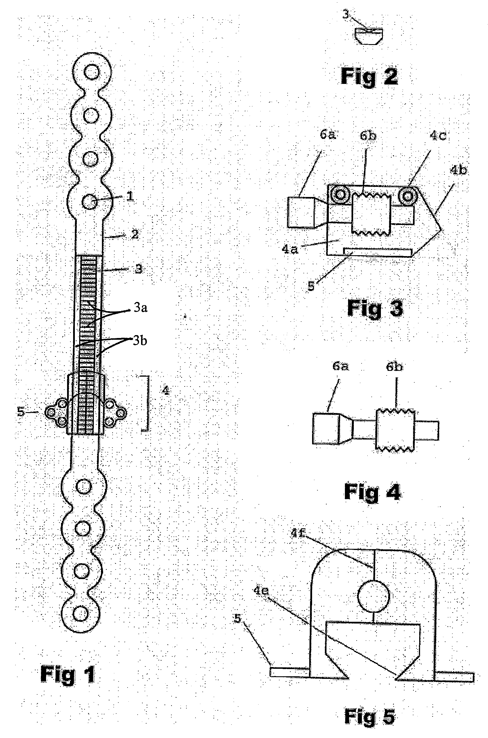 Mandibular Bone Transport Reconstruction Plate